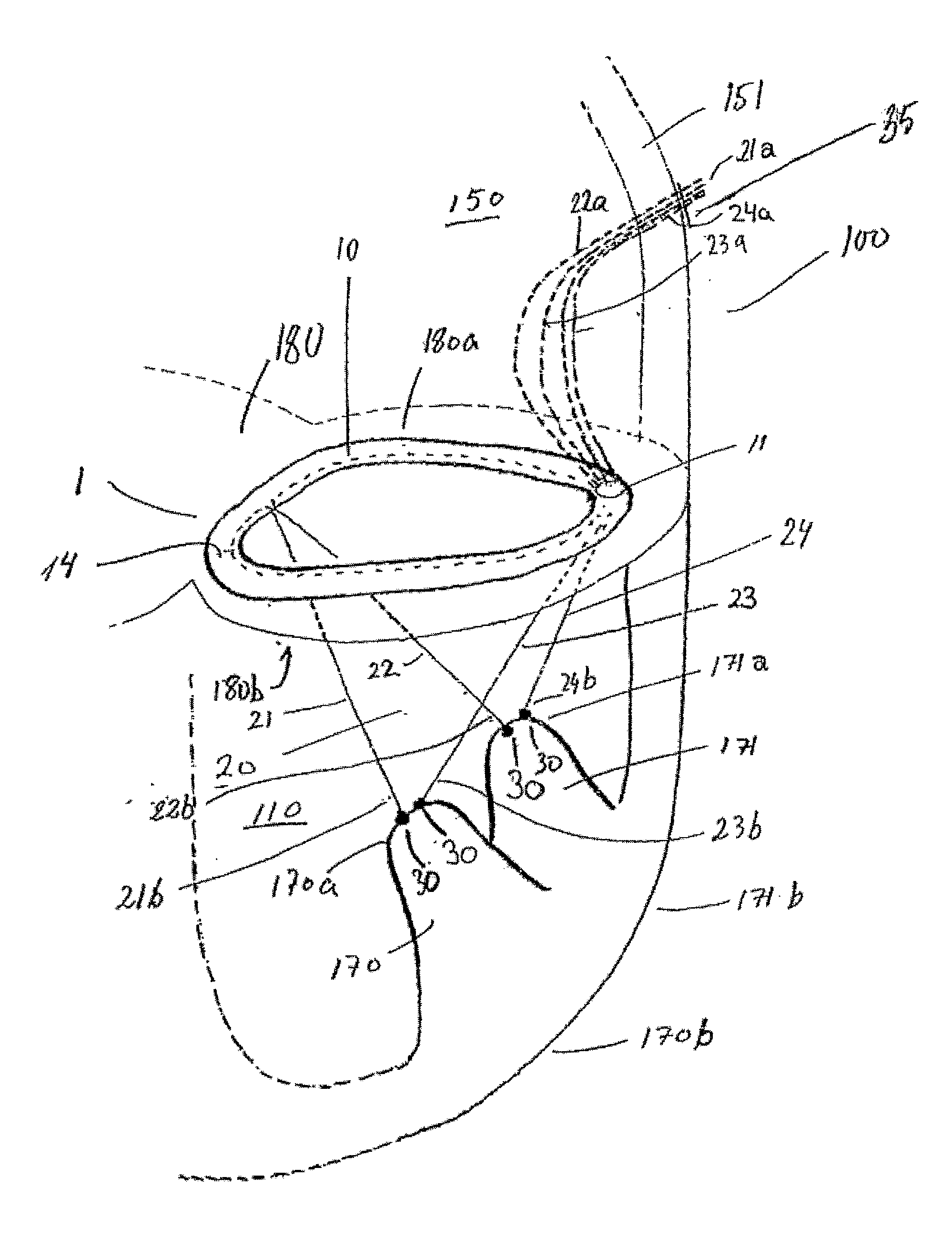 System and a method for altering the geometry of the heart