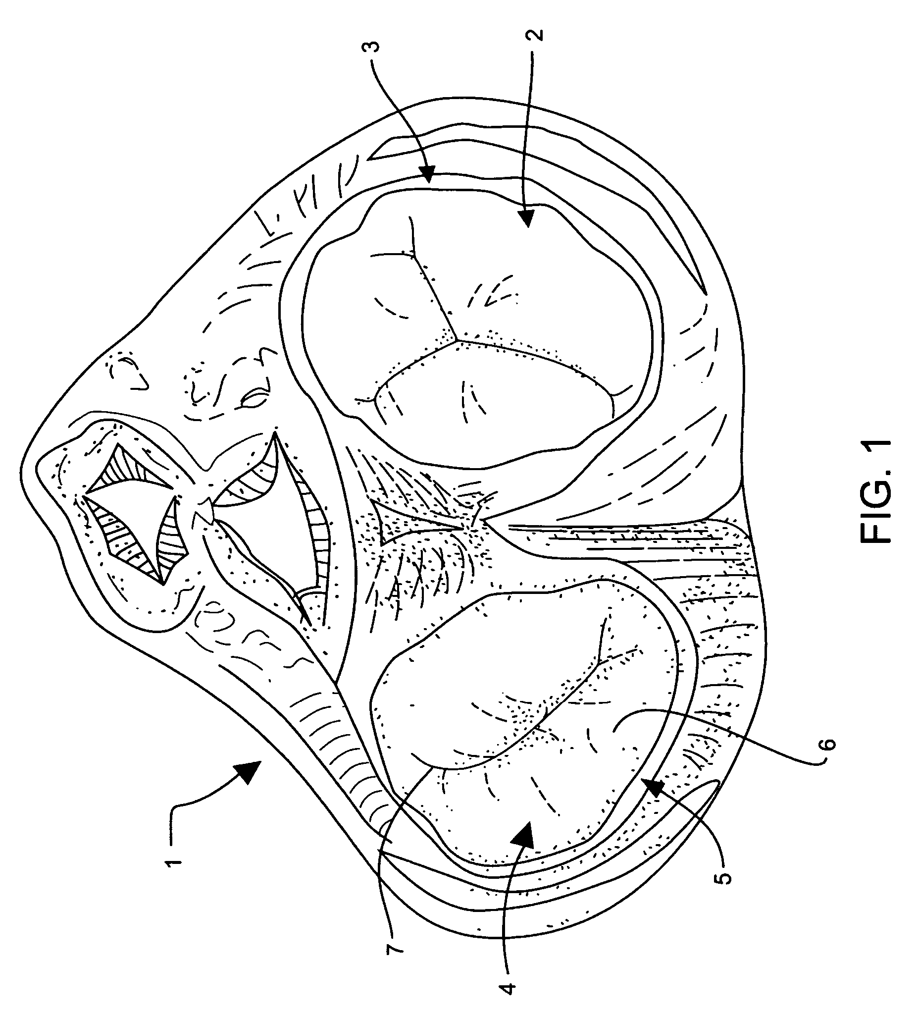 Retainer device for mitral valve leaflets