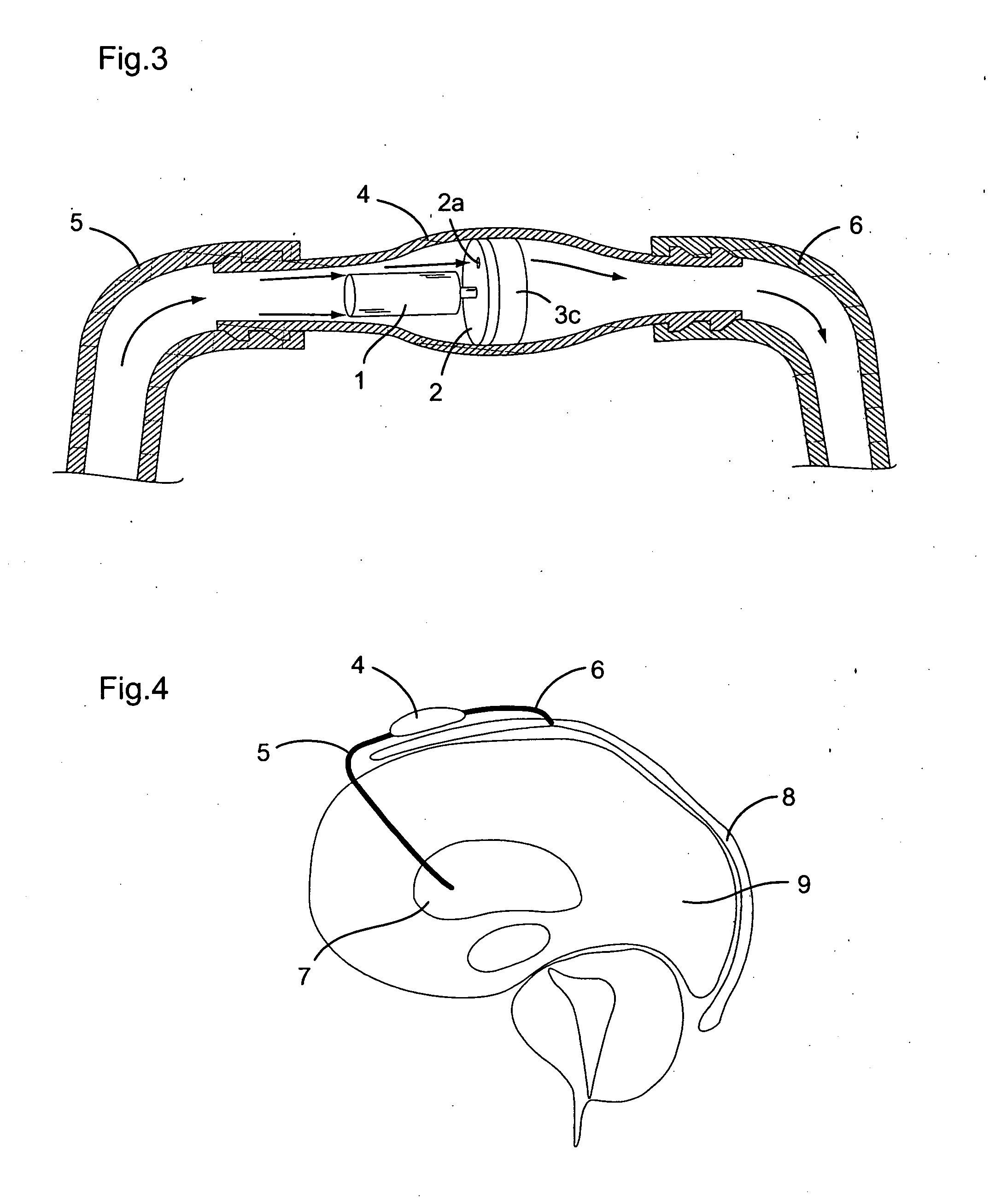 Adjustable resistance valve for a cerebrospinal fluid shunt system