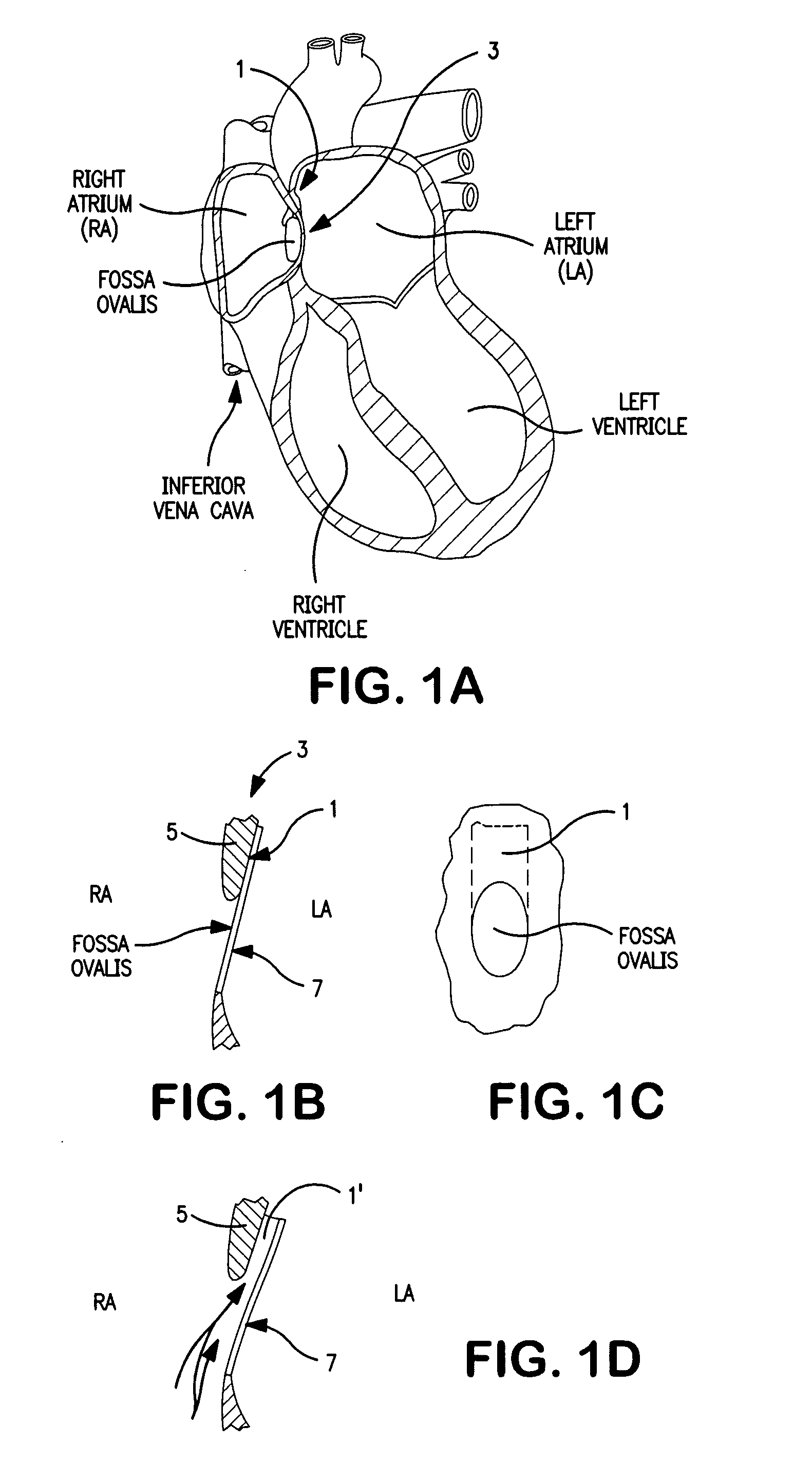 Transseptal closure of a patent foramen ovale and other cardiac defects