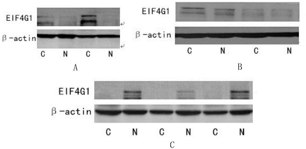 Applications of EIF4G1 in diagnosis and treatment of squamous cell carcinomas