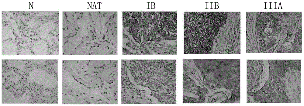 Applications of EIF4G1 in diagnosis and treatment of squamous cell carcinomas