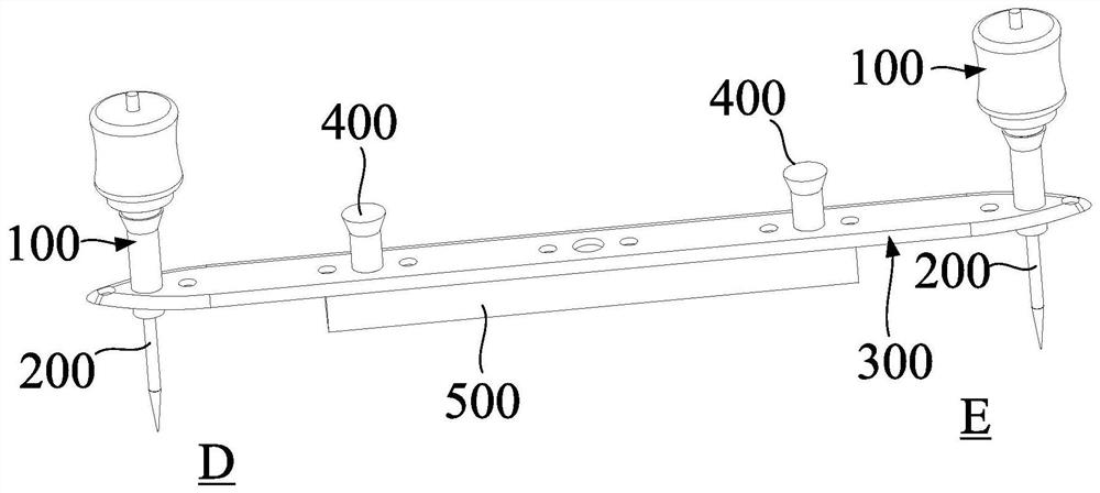 Bone Transport Minimally Invasive Nail-Plate System