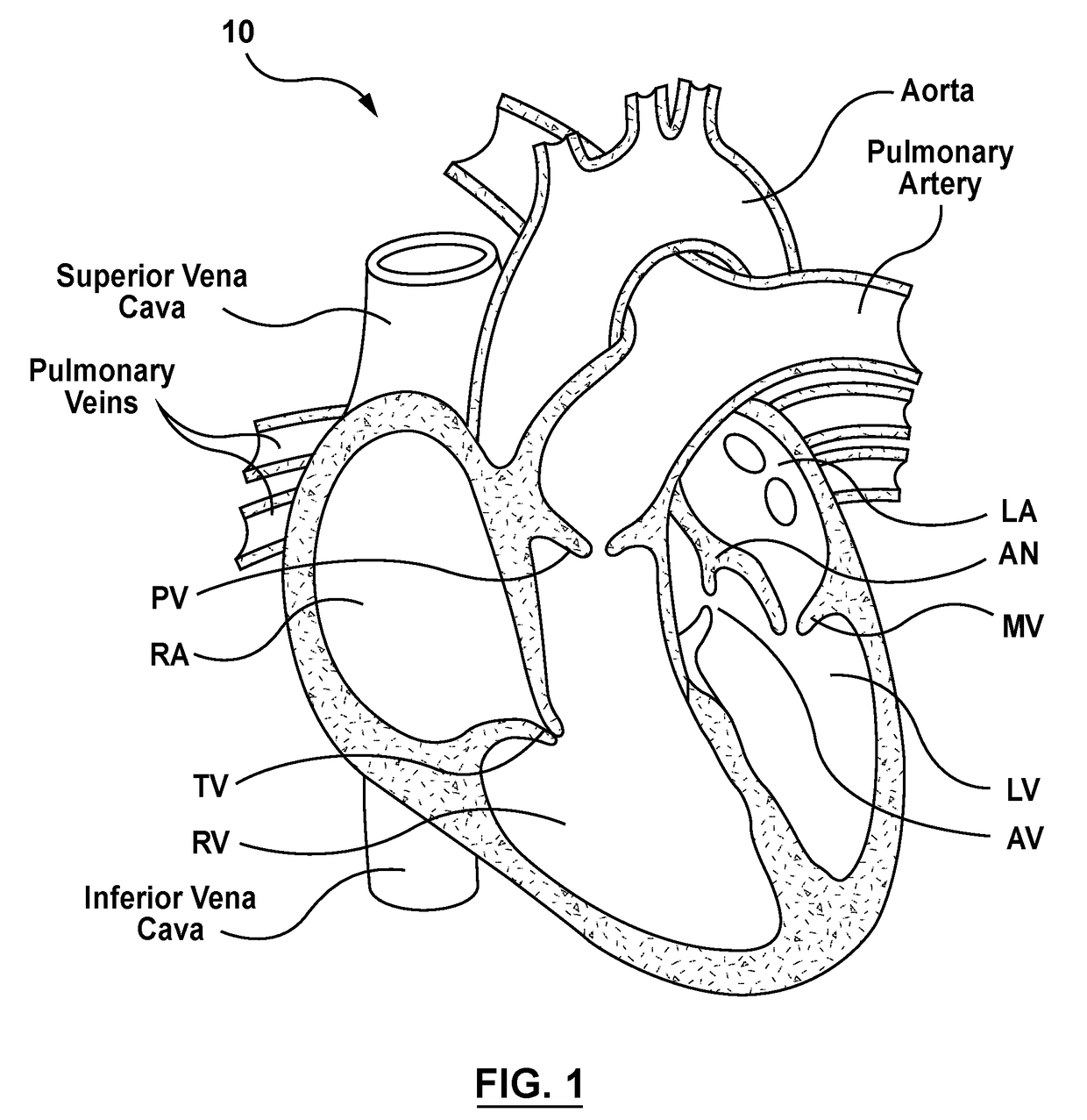 Transcatheter guidewire delivery systems, catheter assemblies for guidewire delivery, and methods for percutaneous guidewire delivery across heart valves