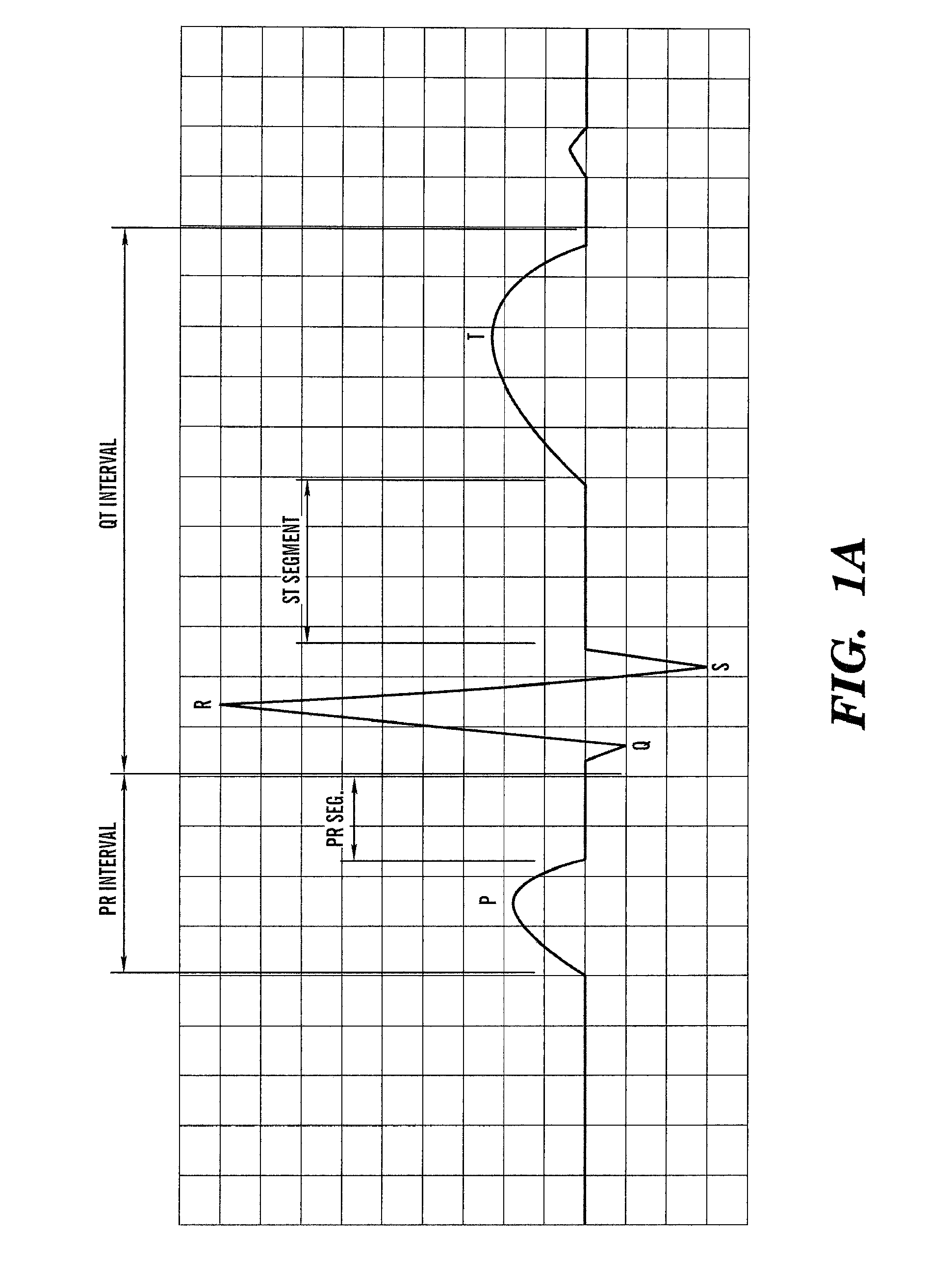 System and method for inferring disease similarity by shape matching of ECG time series