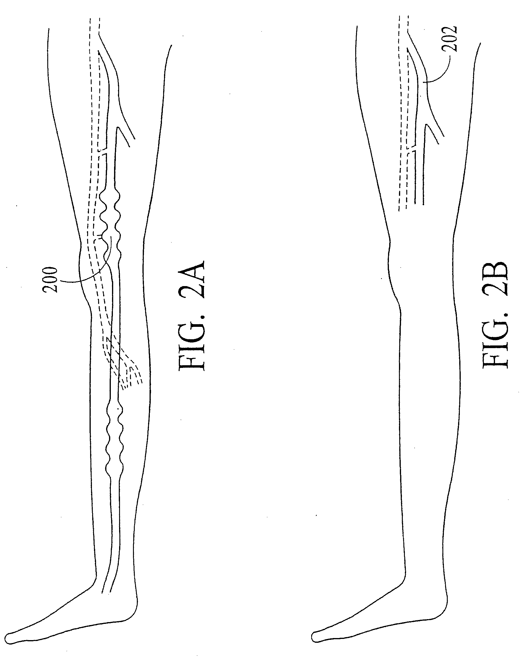 Endovenous Closure of Varicose Veins with Mid Infrared Laser