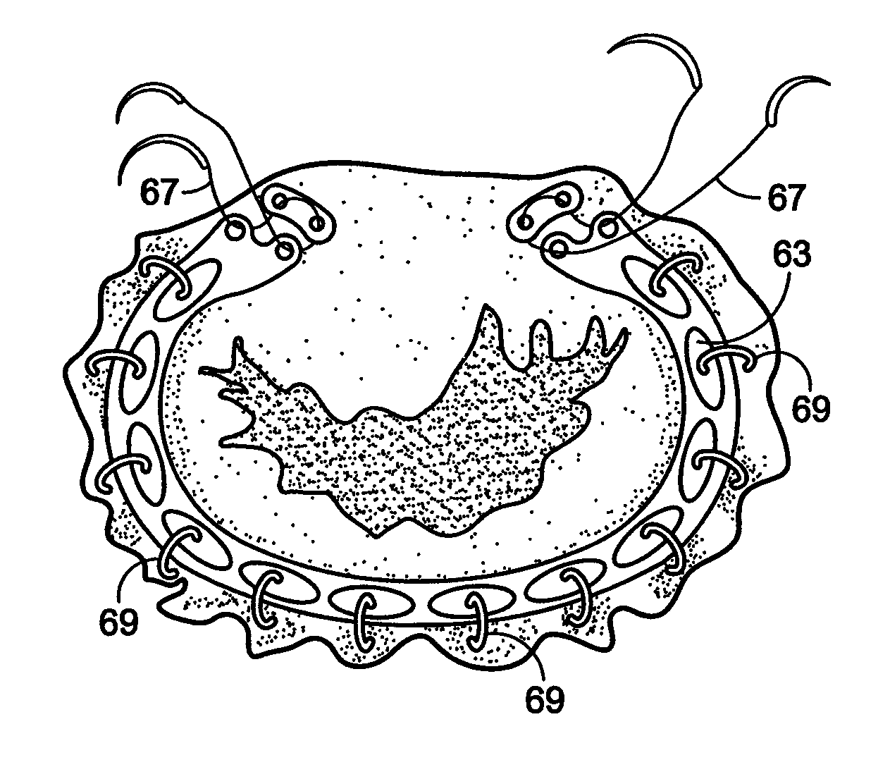 Implantation system for annuloplasty rings