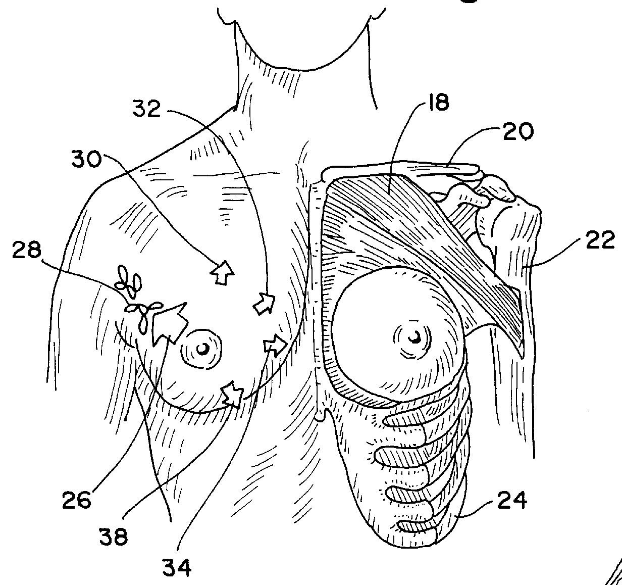 Post-mastectomy garment