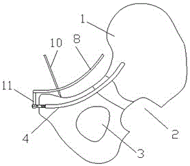 A minimally invasive intramedullary fixation device for pelvic fractures