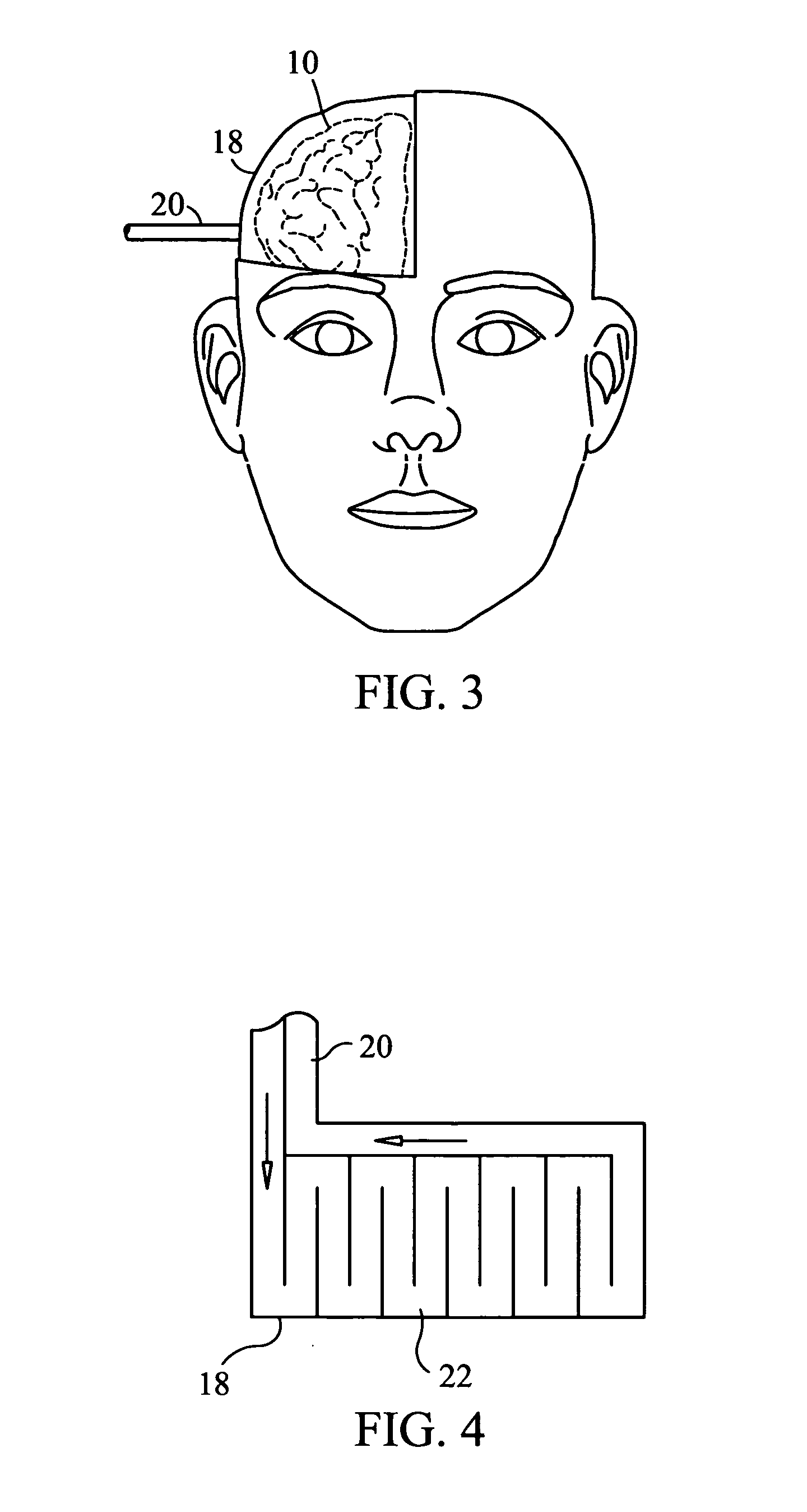 Cooled craniectomy