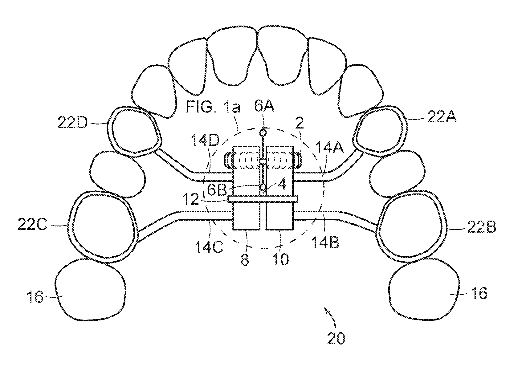 Palatal expansion device and methods