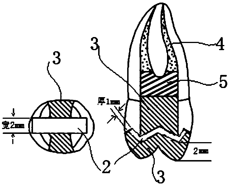 Application of Fiber Tape in Preparation of Penetrating Cracked Molar Restoration