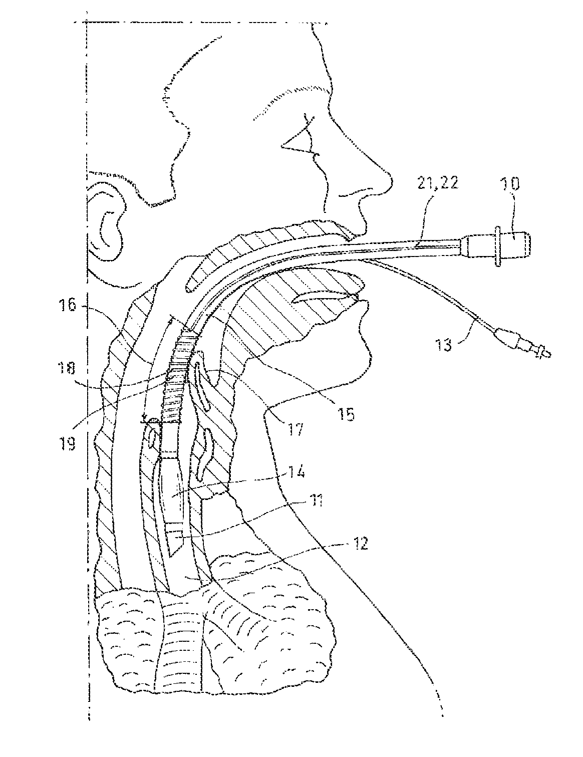 Endotracheal tube