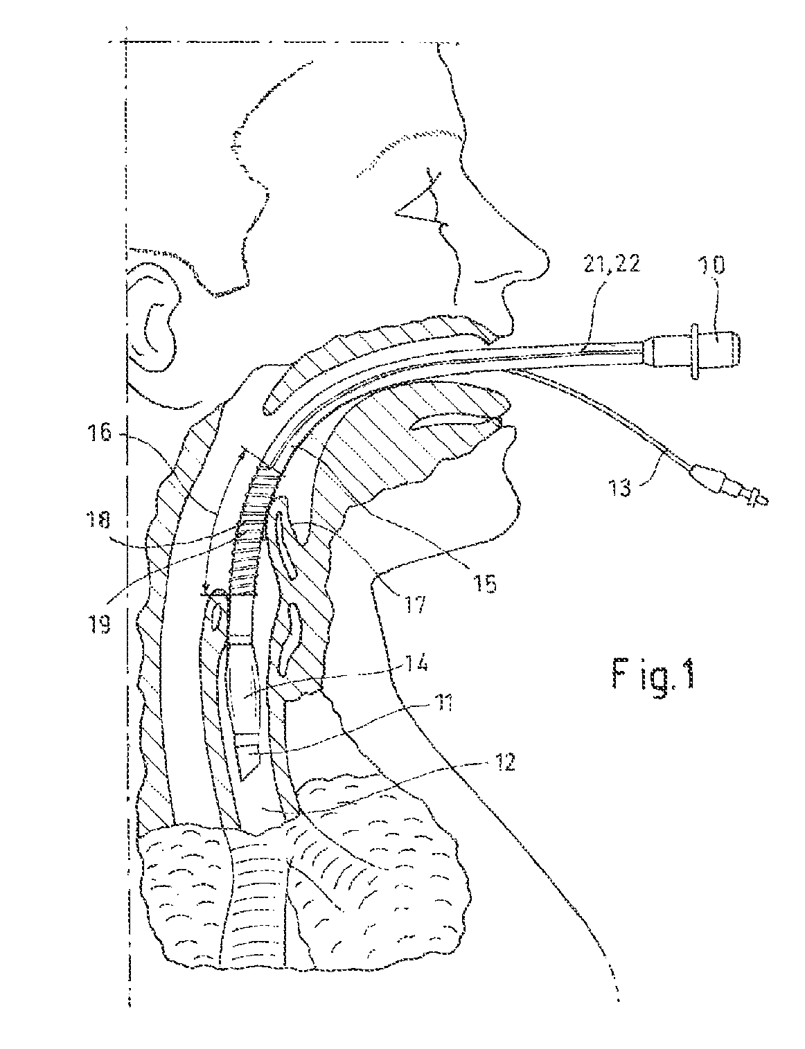 Endotracheal tube