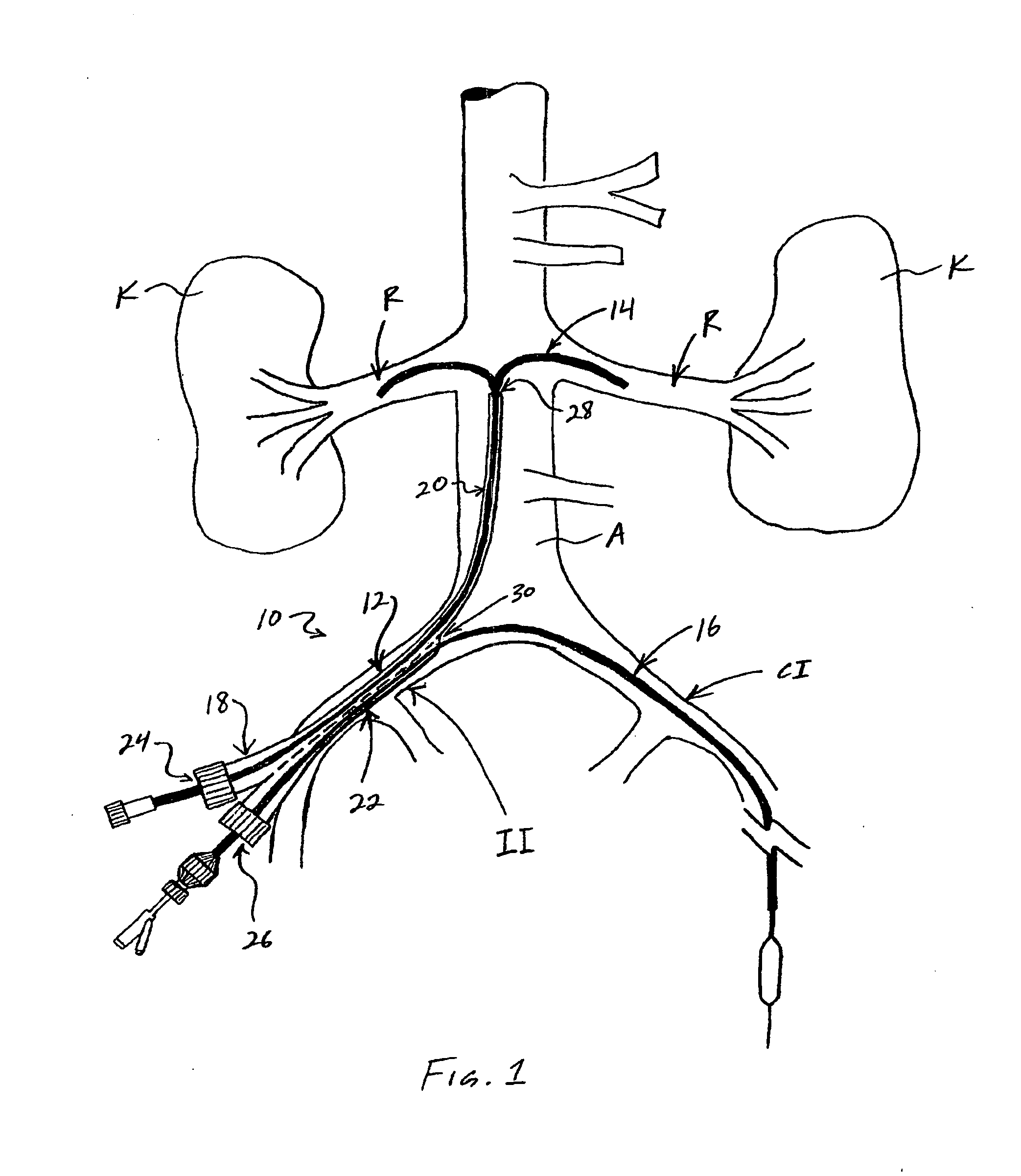 Sheath for use in peripheral interventions