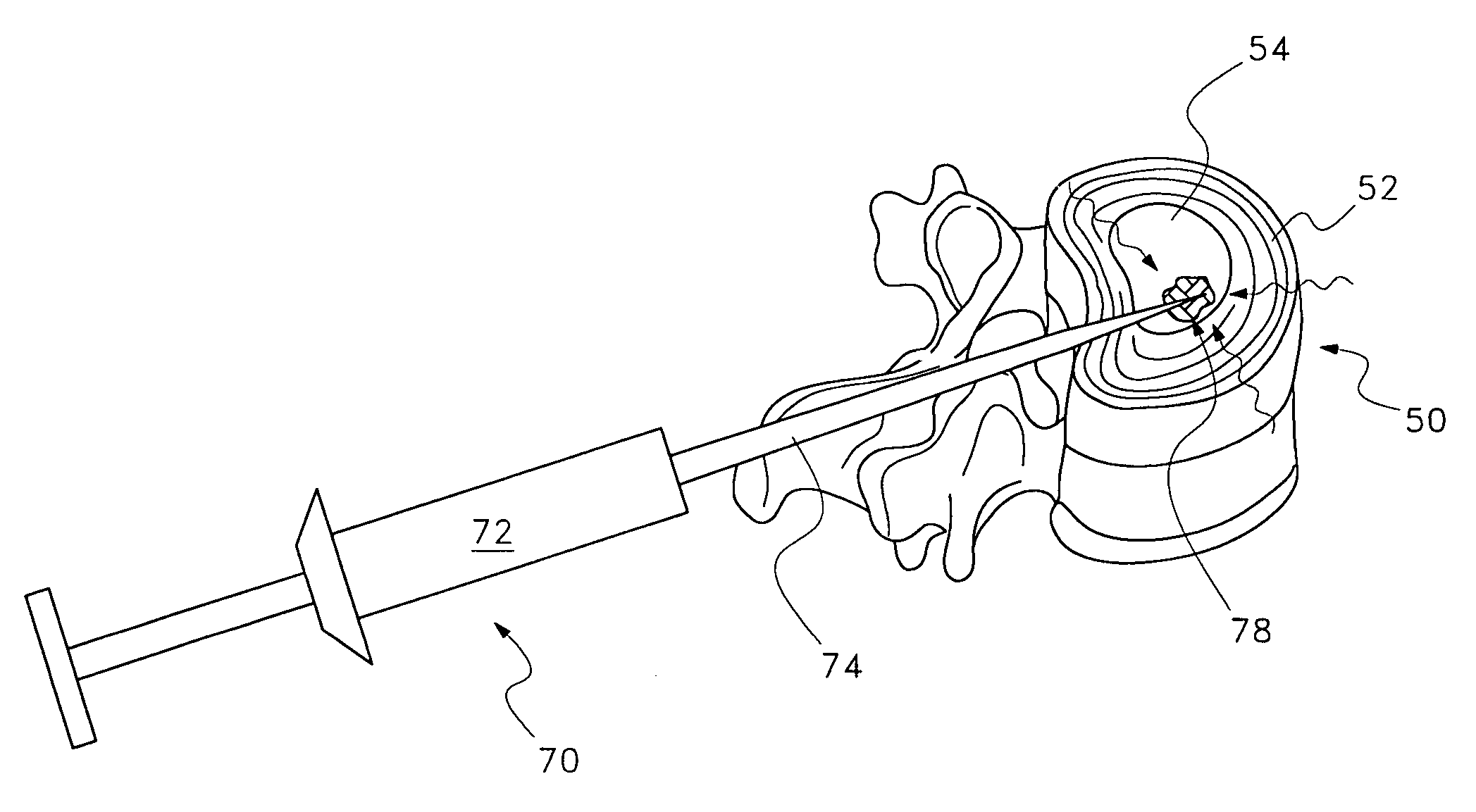 Hygroscopic treatment for degenerating discs