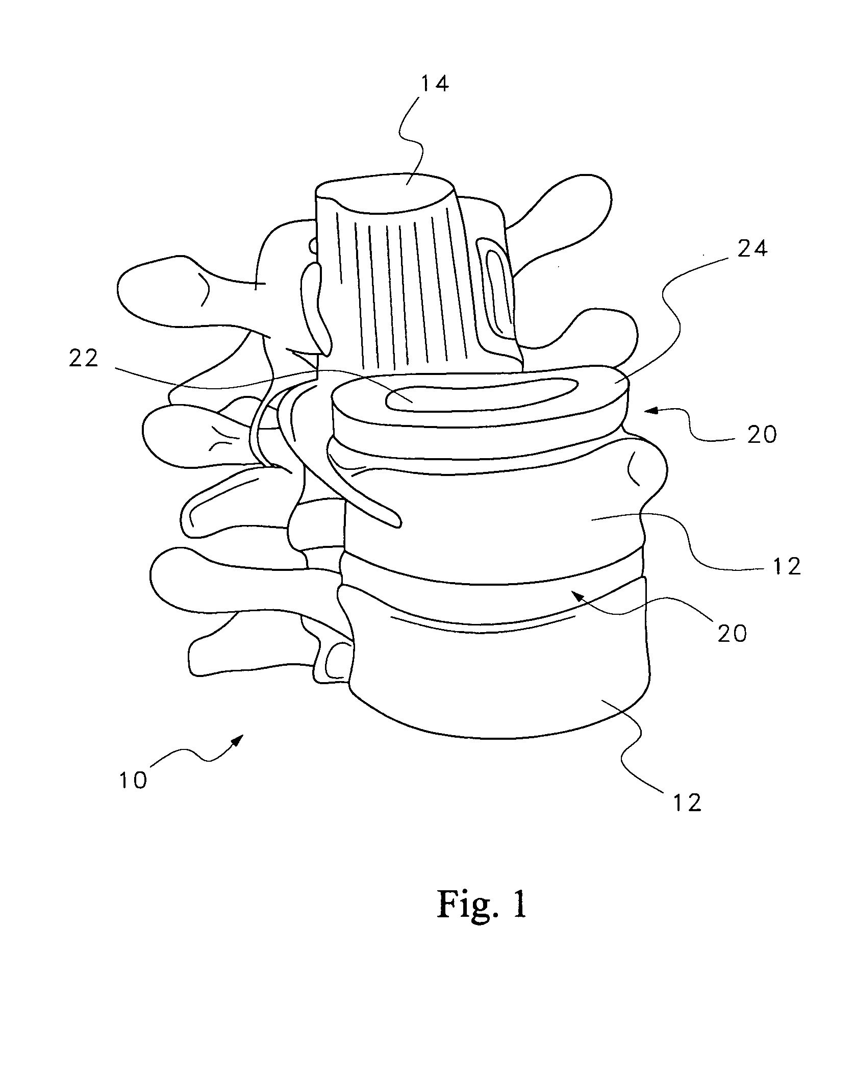 Hygroscopic treatment for degenerating discs