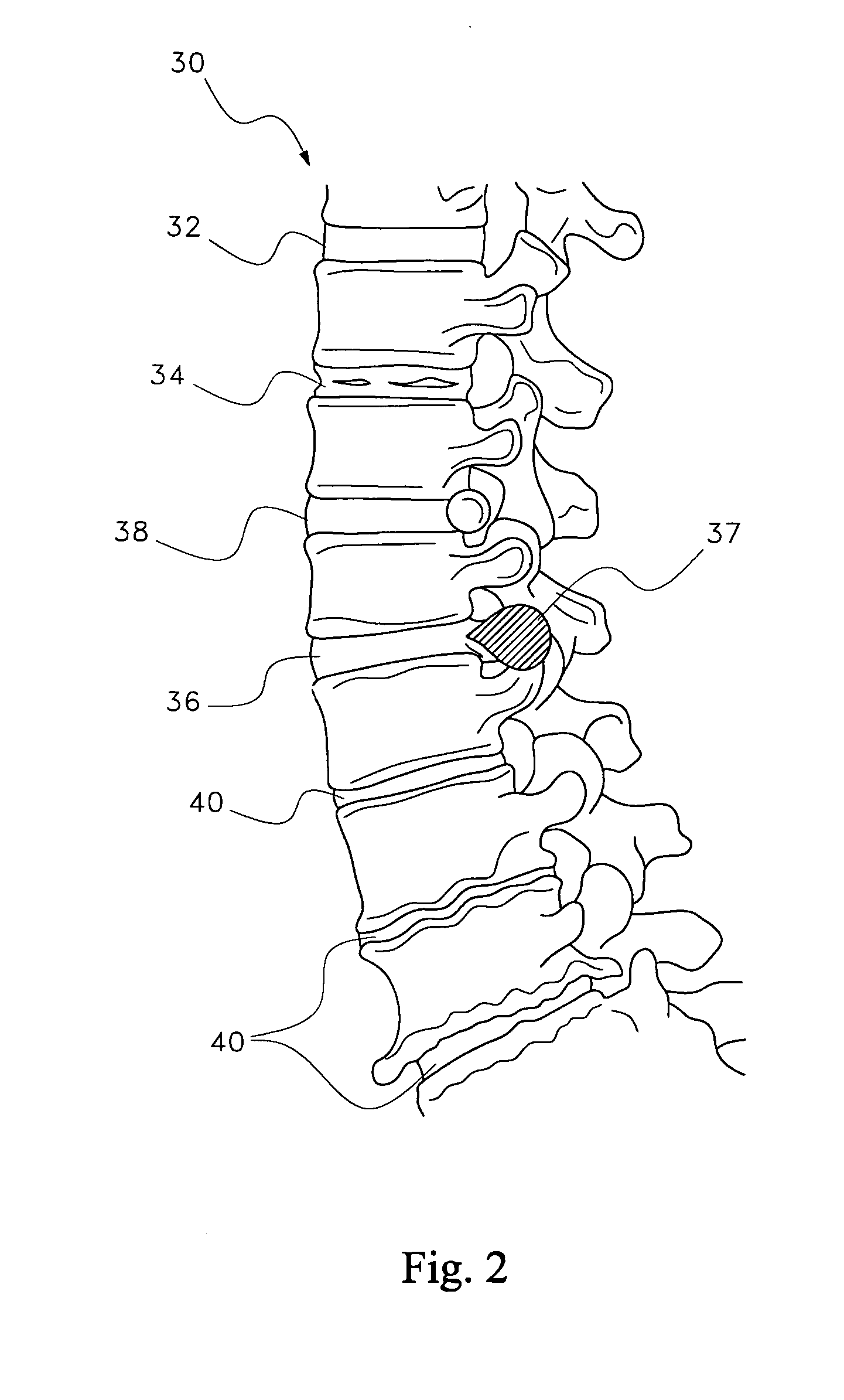 Hygroscopic treatment for degenerating discs