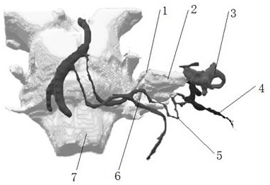 A kind of acoustic neuroma model based on mr image and preparation method thereof