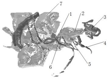 A kind of acoustic neuroma model based on mr image and preparation method thereof