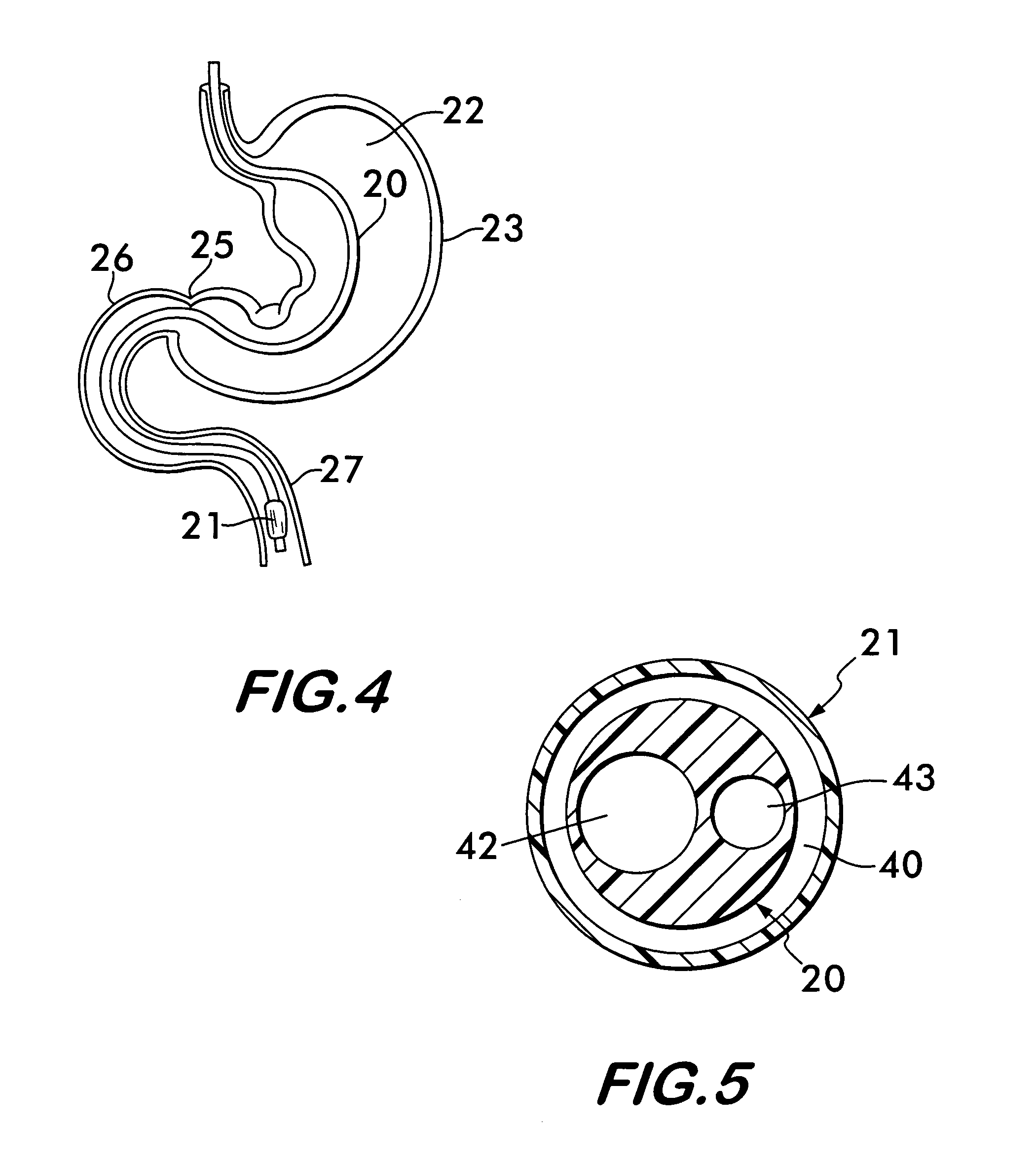 Gastrojejunal feeding tube