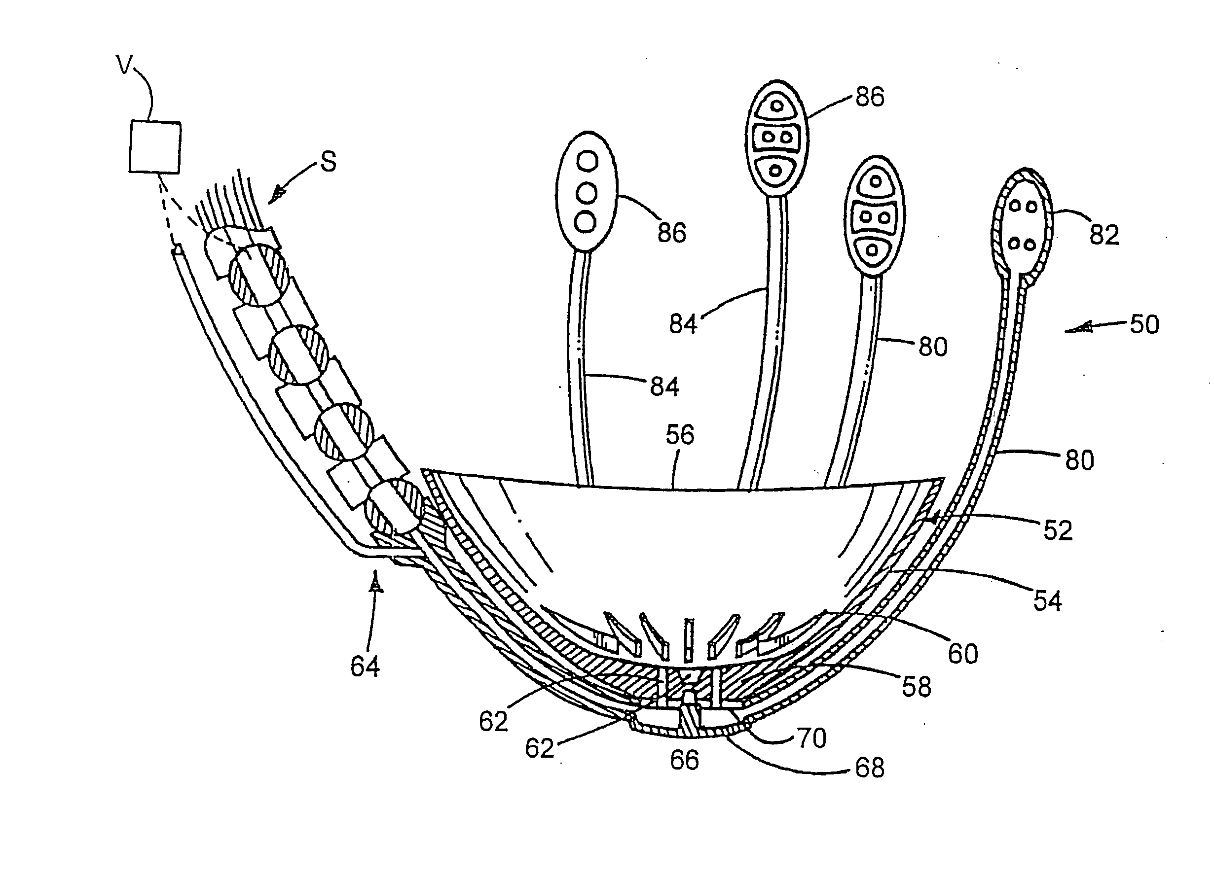 Device to permit offpump beating heart coronary bypass surgery