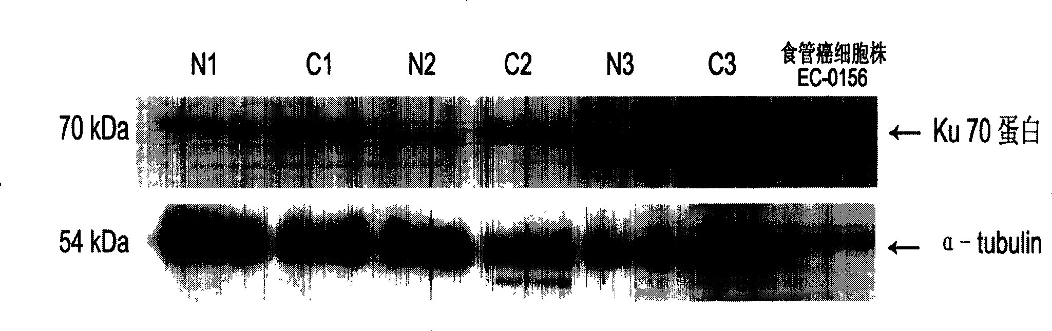 A method for detecting tumor-related markers in serum of patients with esophageal cancer