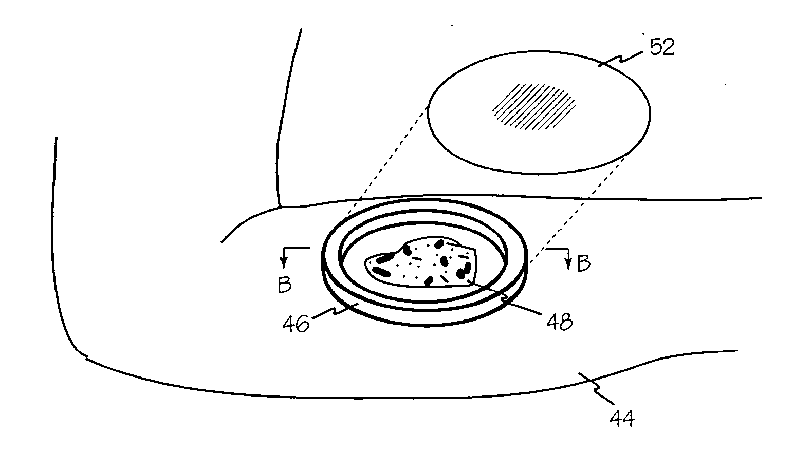 Wound shield