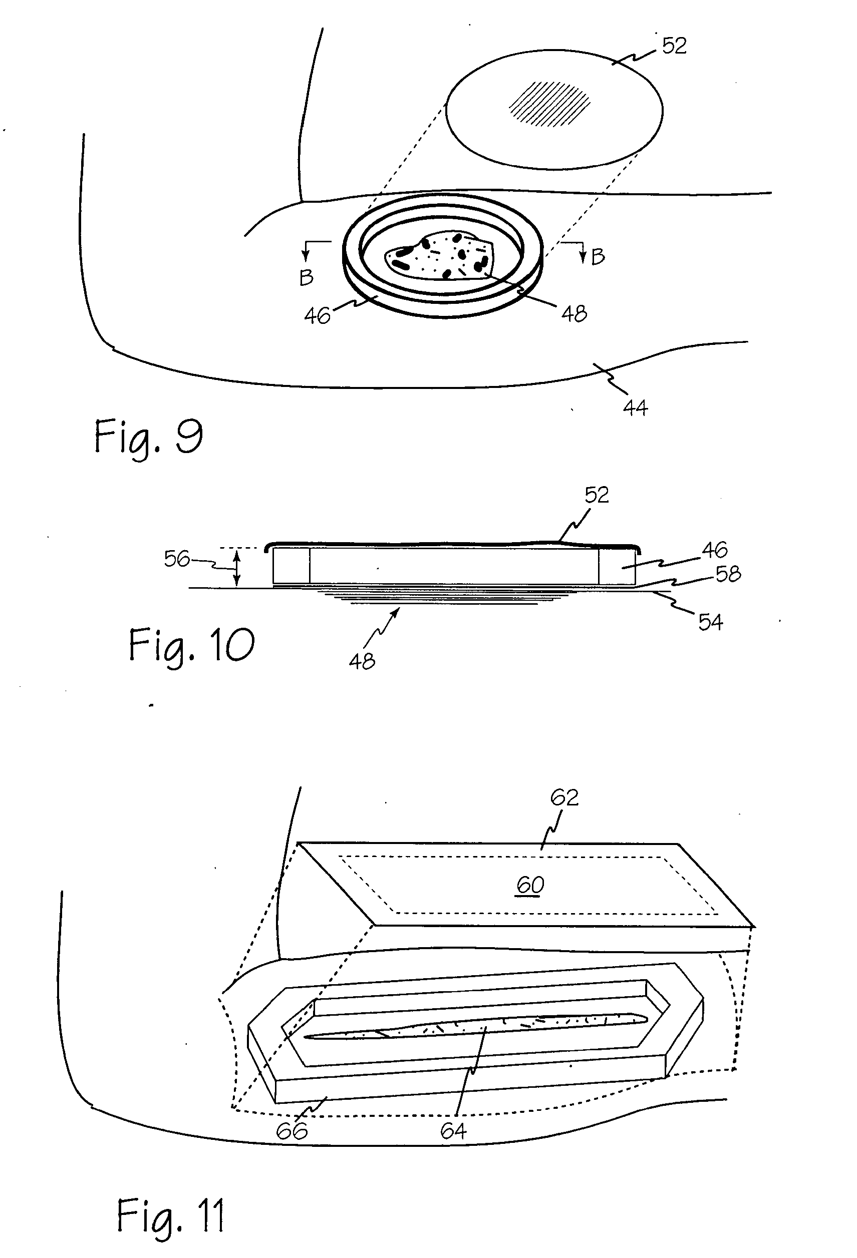 Wound shield