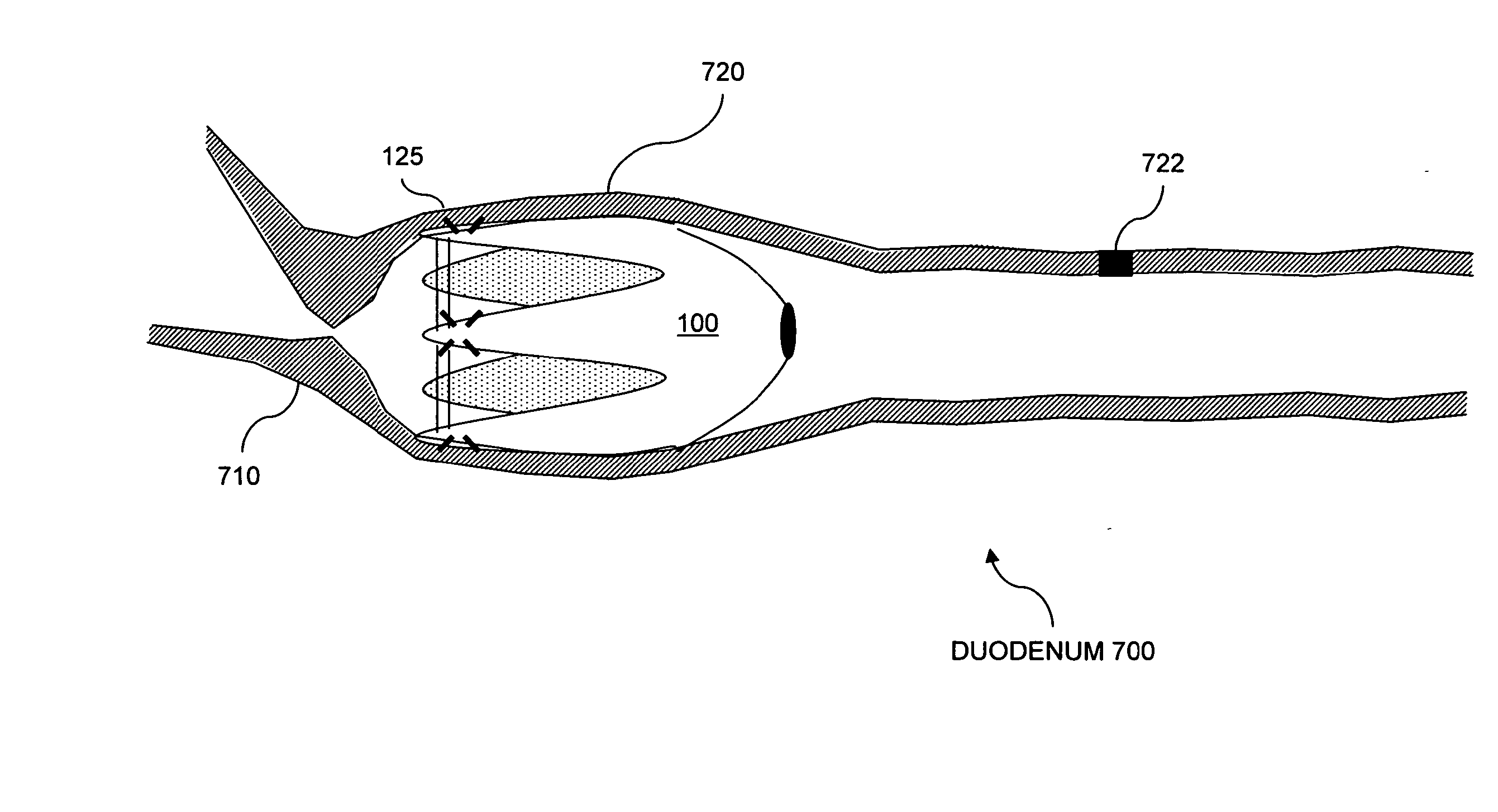 Resistive anti-obesity devices