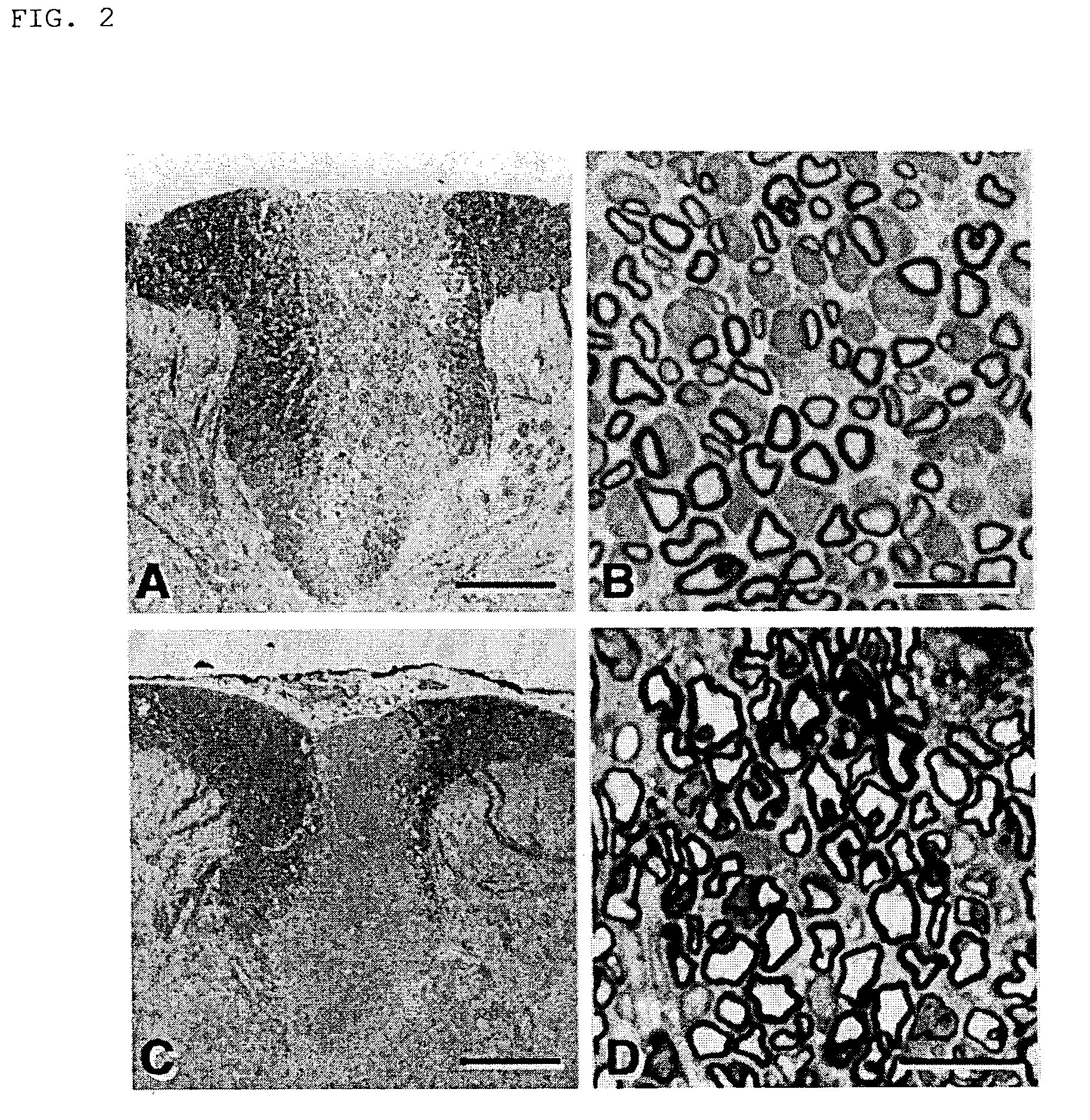 Method for remyelinating a demyelinized lesion due to injury in the brain or spinal cord