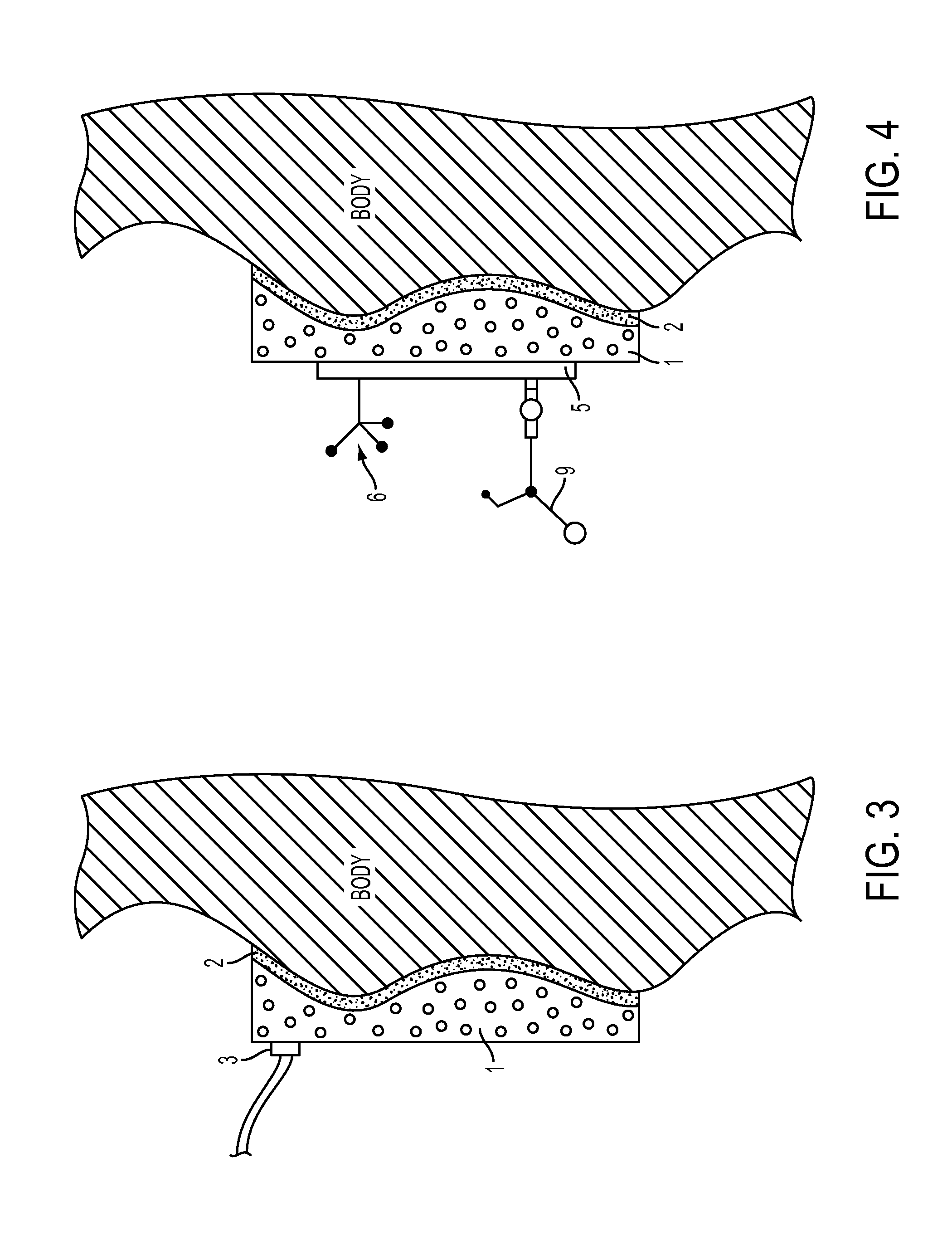 Immobilization Device