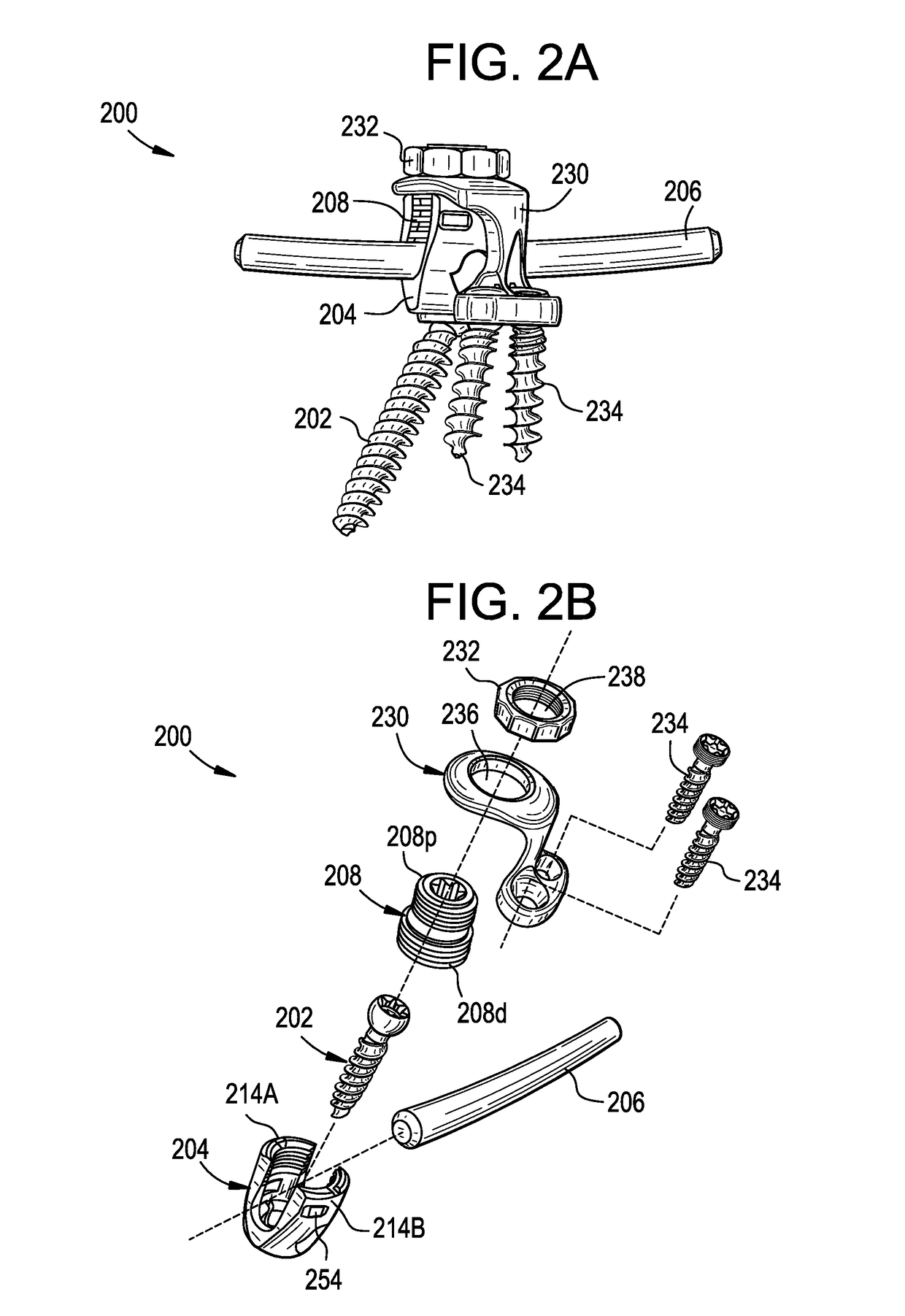 Multipoint fixation implants