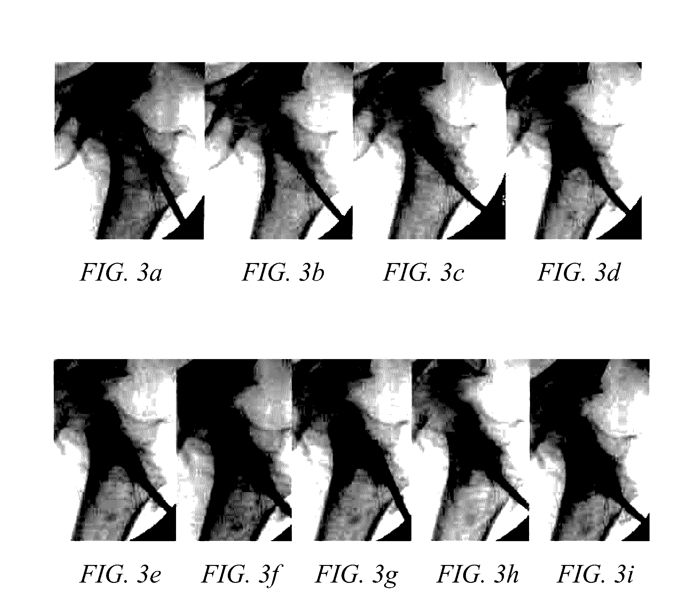 Methods of treating degenerative bone conditions