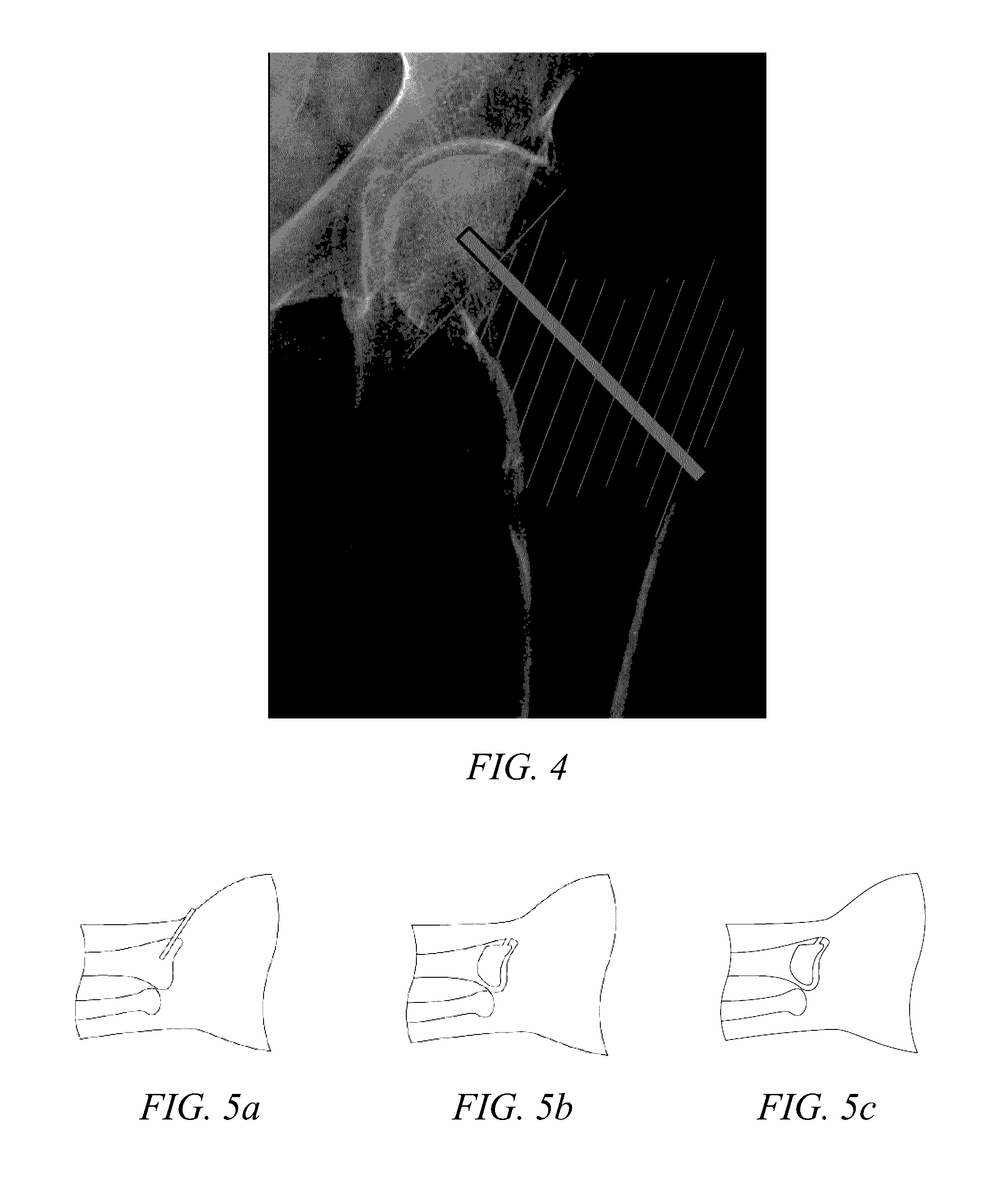 Methods of treating degenerative bone conditions