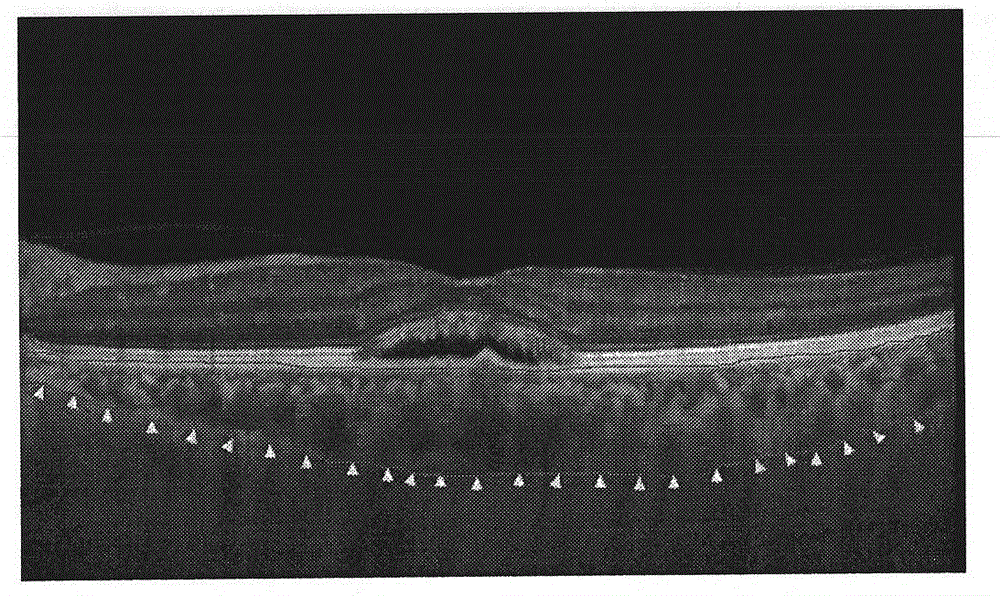 Method for measuring diameter of maximum choroid blood vessel based on image segmentation