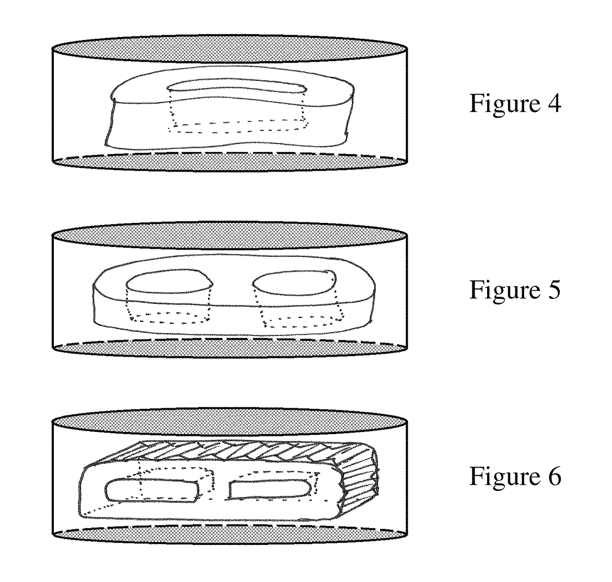 Sac for use in spinal surgery