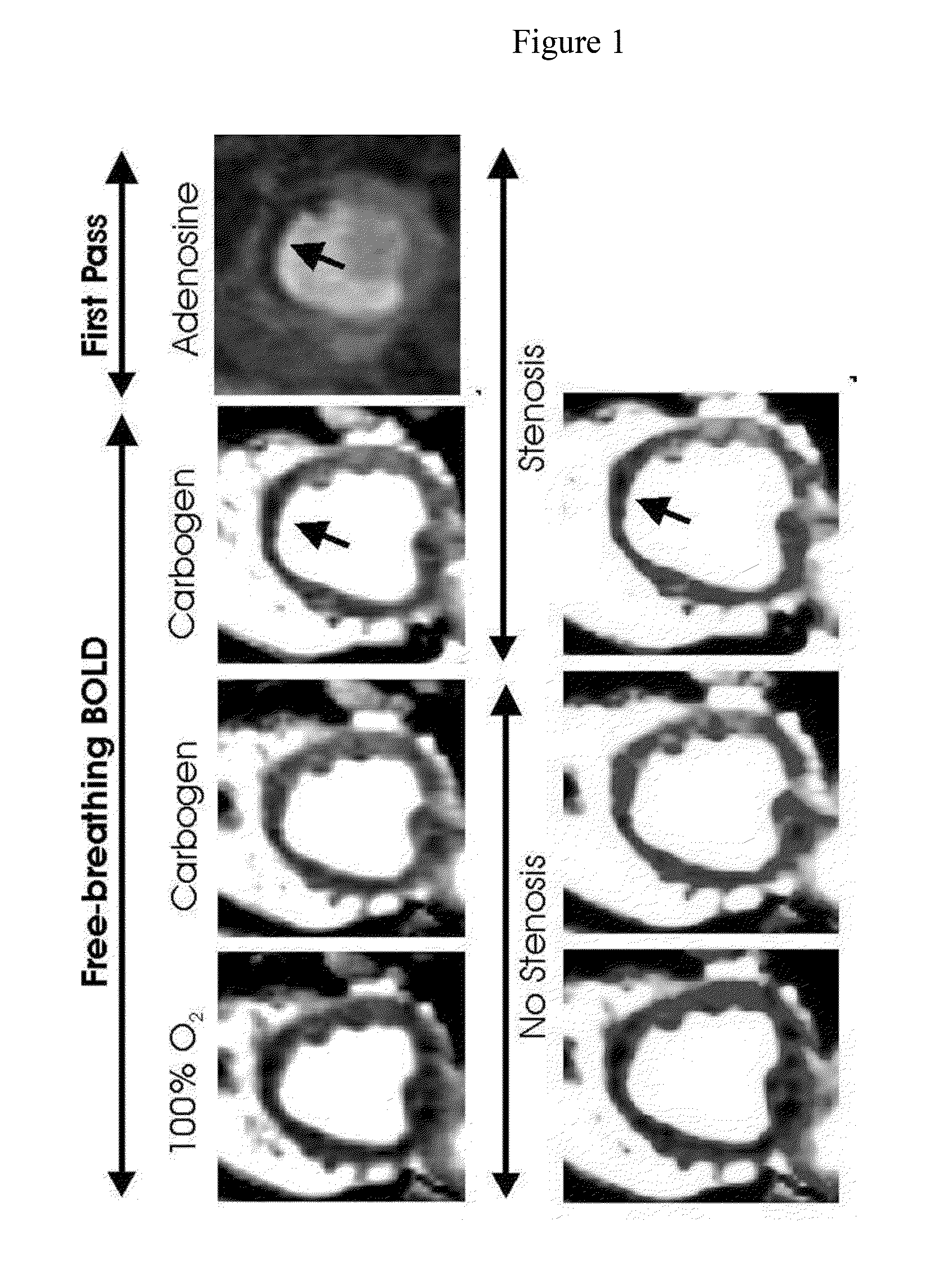 Assessment of coronary heart disease with carbon dioxide