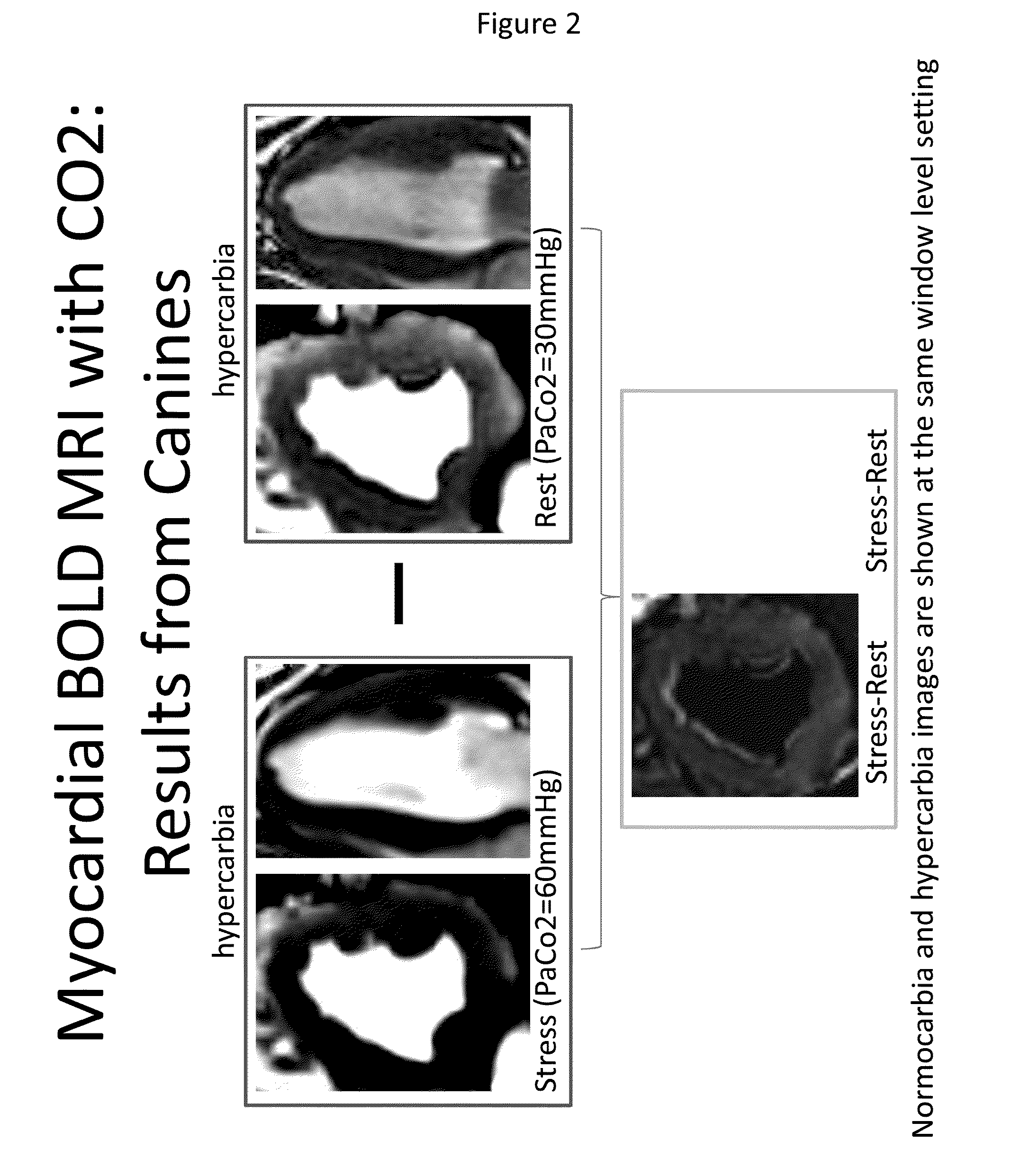 Assessment of coronary heart disease with carbon dioxide