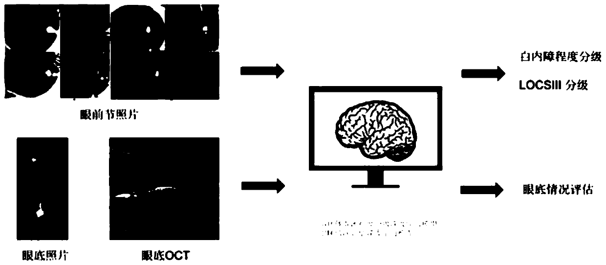 High myopia cataract surgery prognosis intelligent pre-judging system