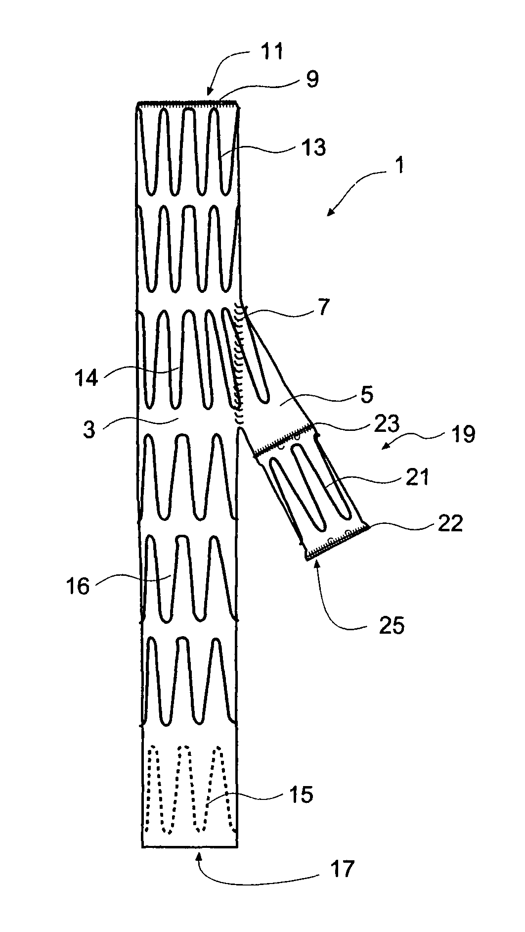 Iliac artery stent graft