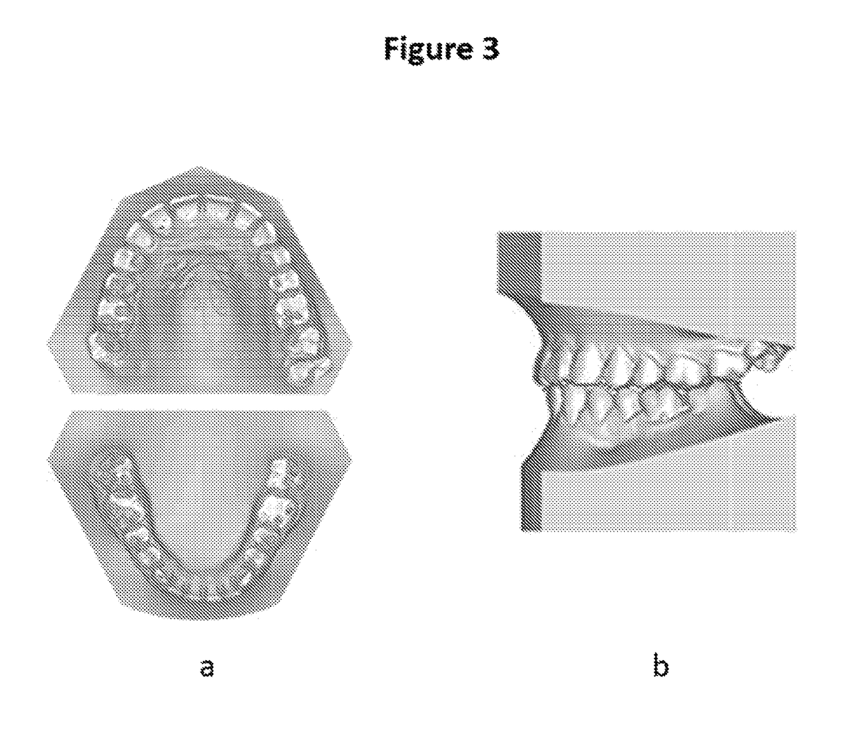 Capacitive Sensor Array for Dental Occlusion Monitoring