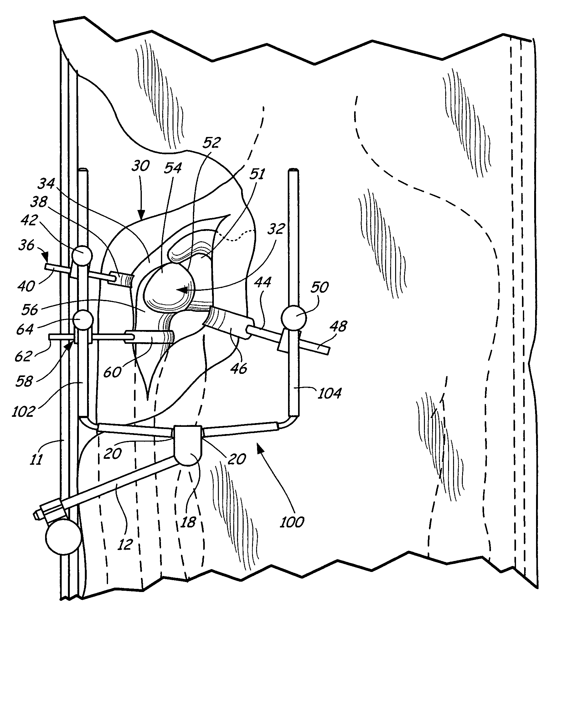 Method of performing shoulder surgery