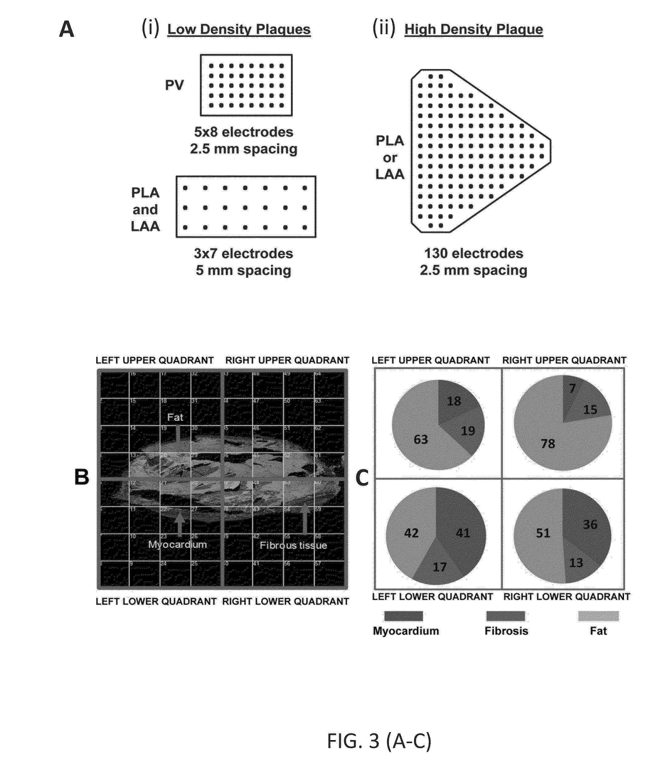 Inhibition of fibrosis and AF by TGF-beta inhibition in the posterior left atrium (PLA)