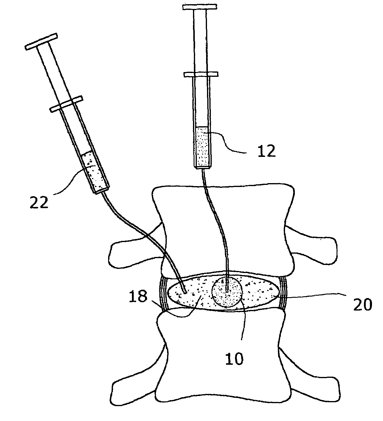 Inflatable nuclear prosthesis