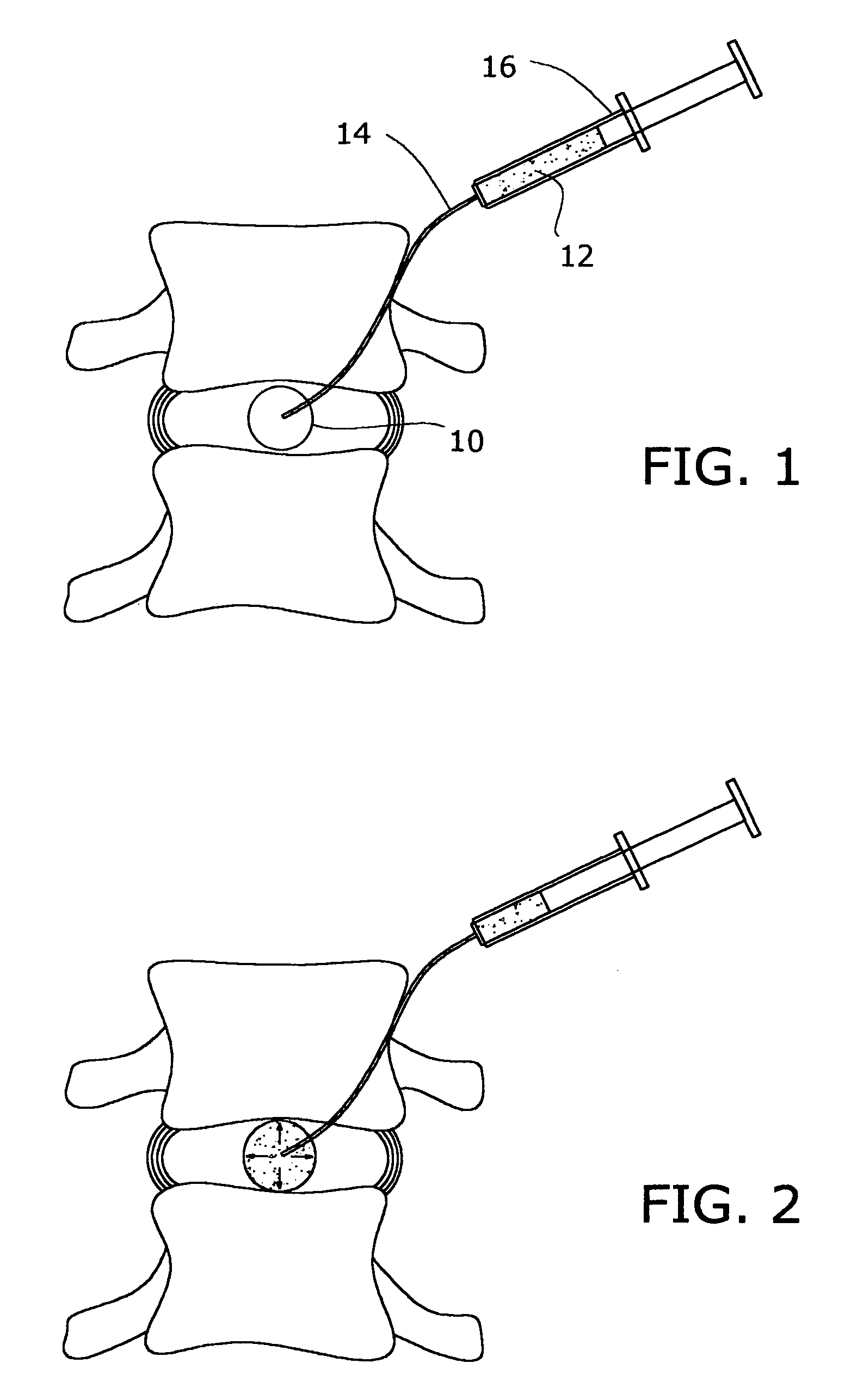 Inflatable nuclear prosthesis