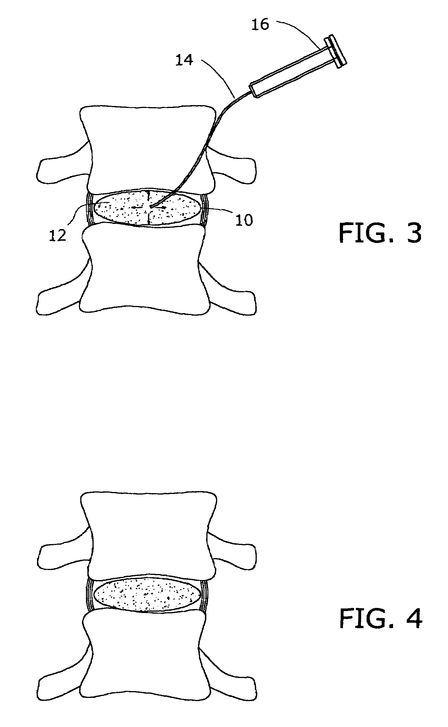 Inflatable nuclear prosthesis