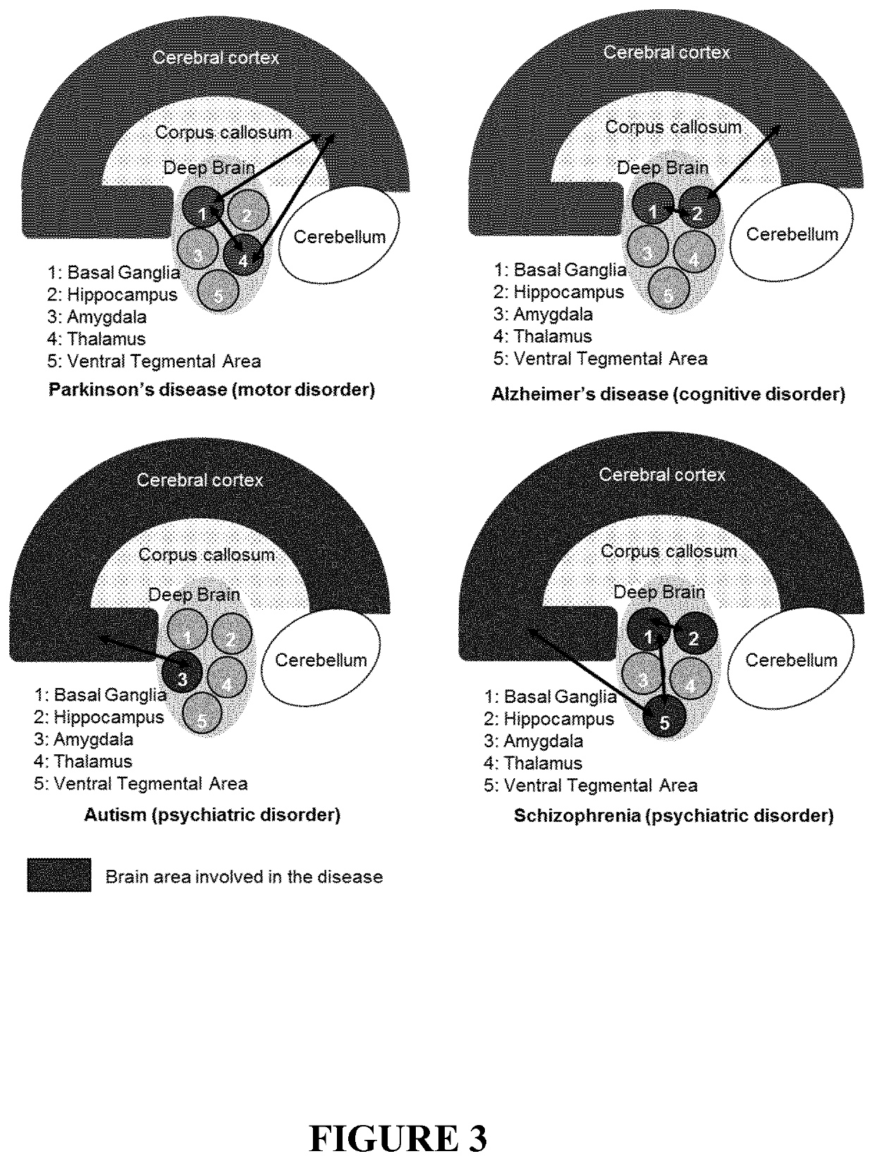 Nanoparticles for use for treating a neuronal disorder