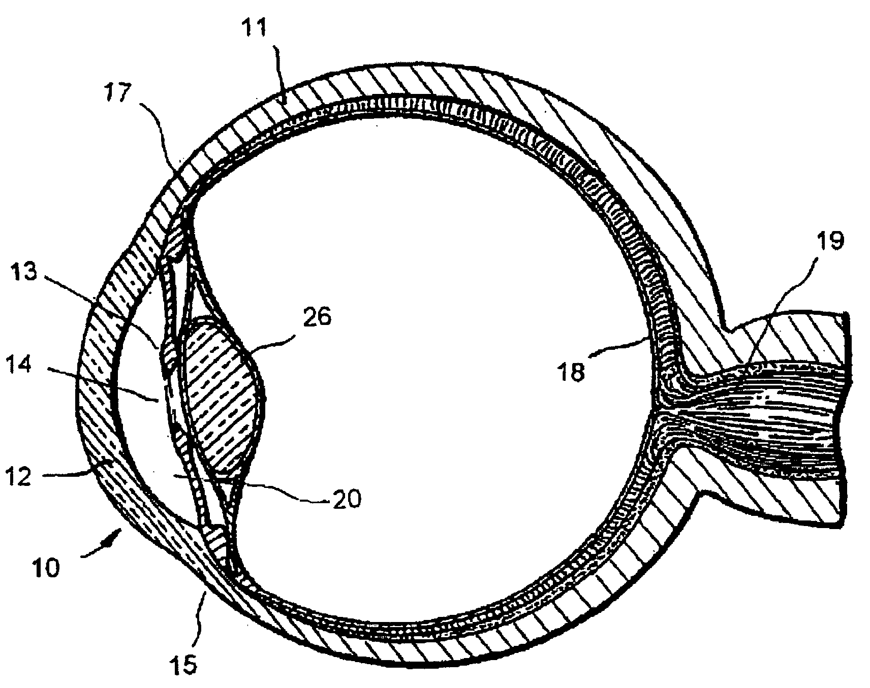 Glaucoma implant with multiple openings