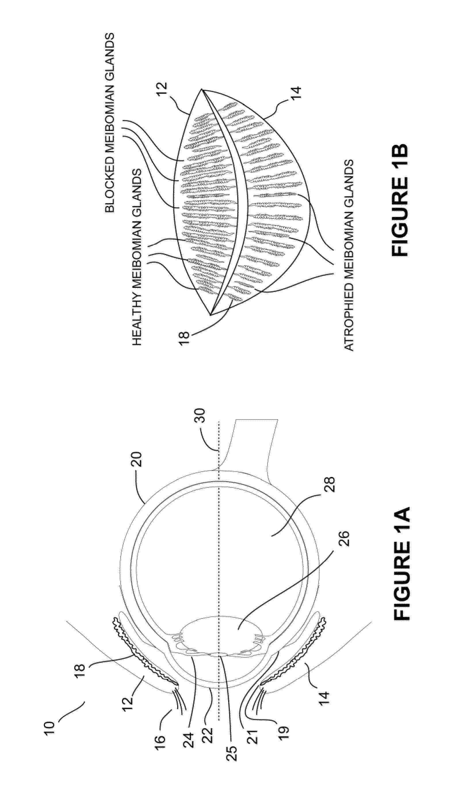 Systems and methods for the treatment of eye conditions